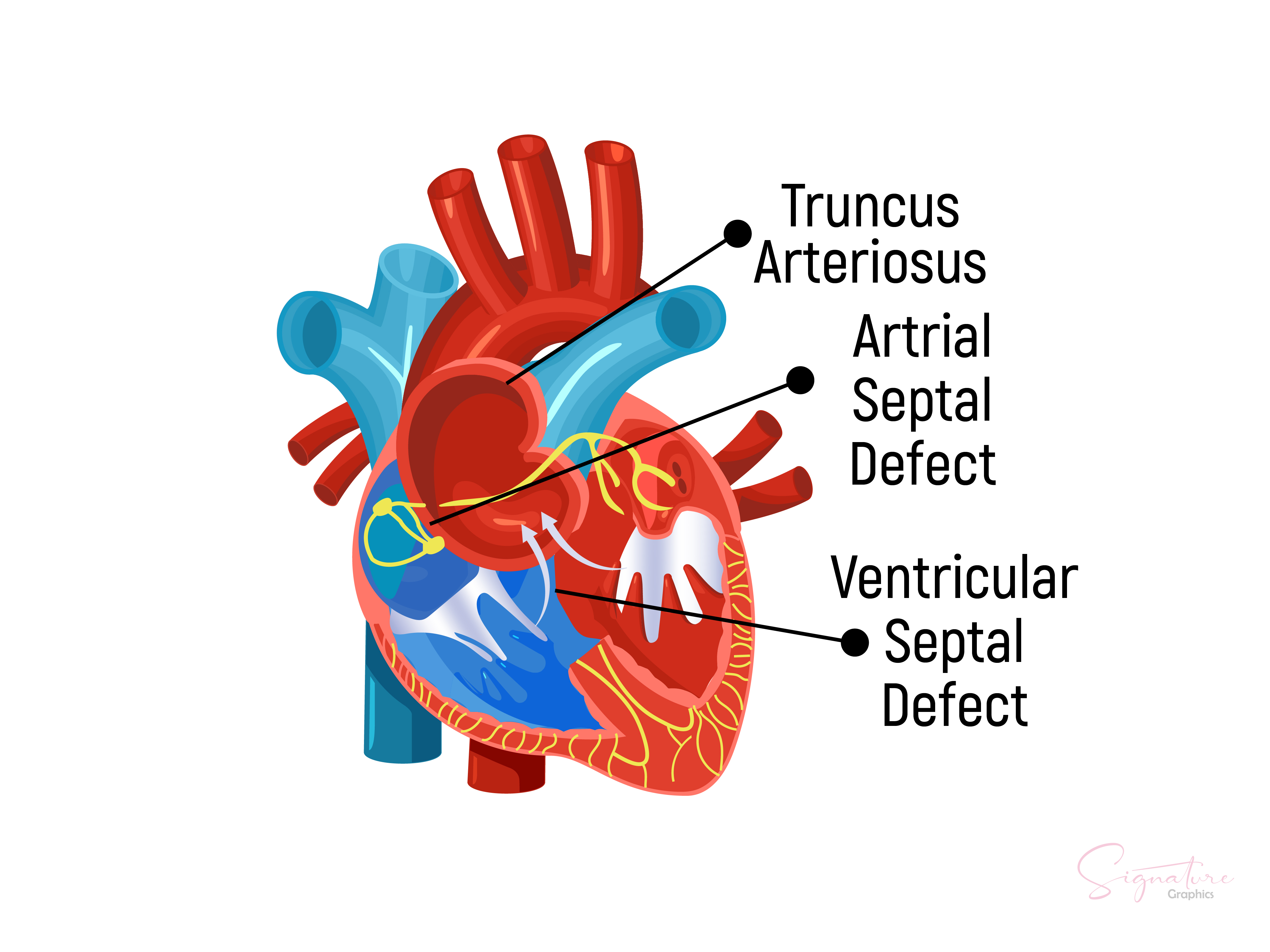 This image illustrates atrial septal defect, ventricle septal defect, and truncus arteriosus.