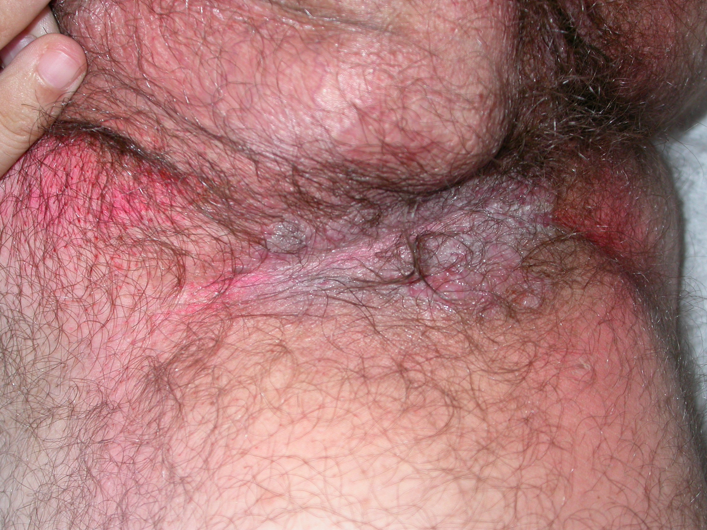 Erythematous macerated plaques with crusted erosions of the right inguinal fold