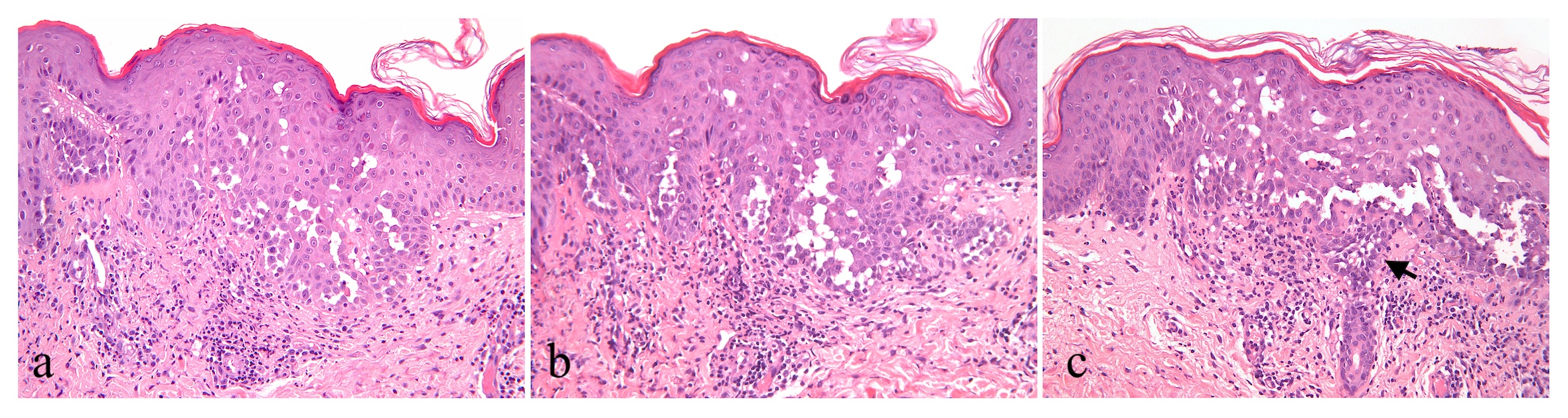Suprabasal acantholysis with acantholytic cells characteristically throughout most of thickness of the hyperplastic epidermis giving the appearance of a dilapidated brick wall (a,b,c)