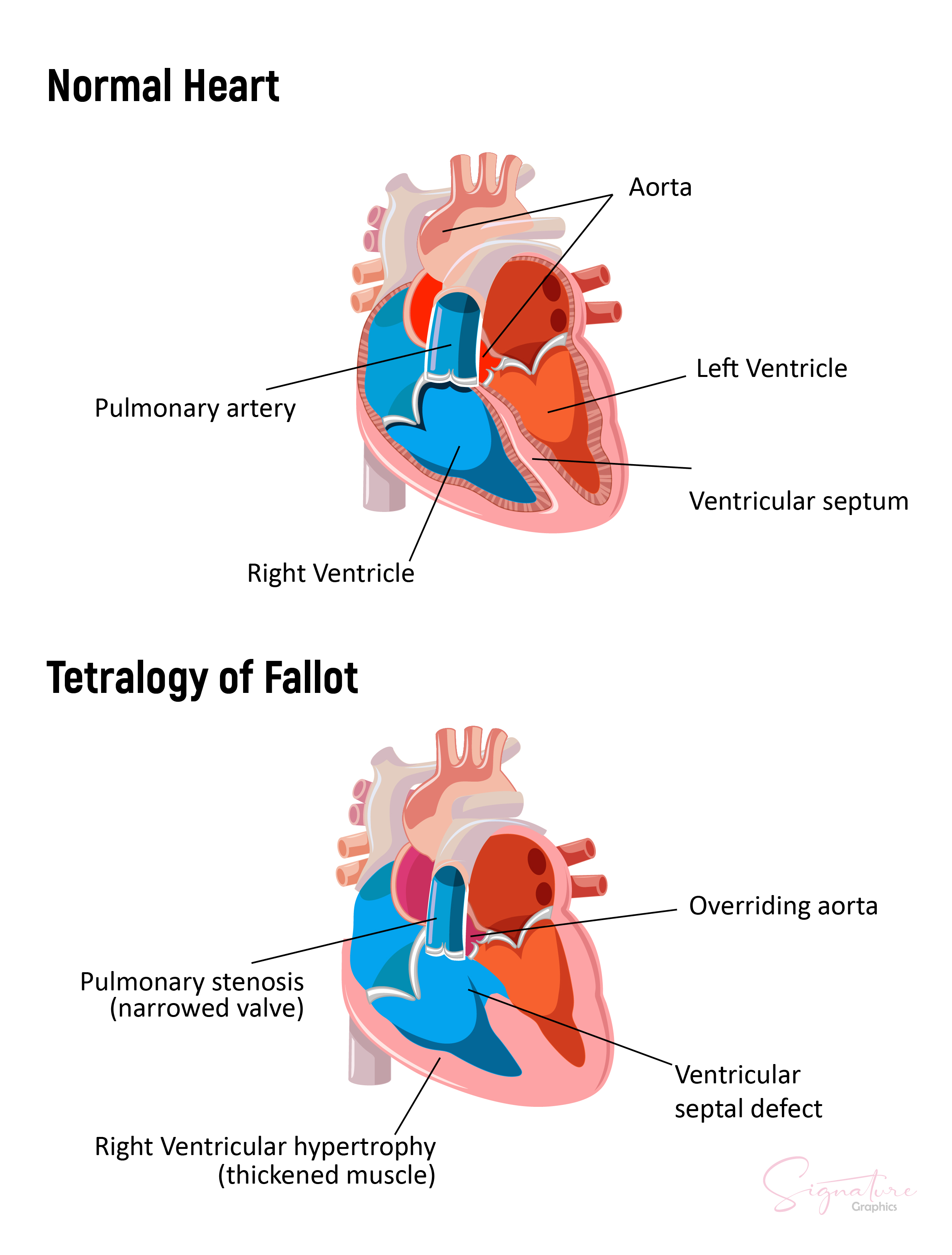 This image illustrates differences between a normal heart and a heart with tetralogy of Fallot.