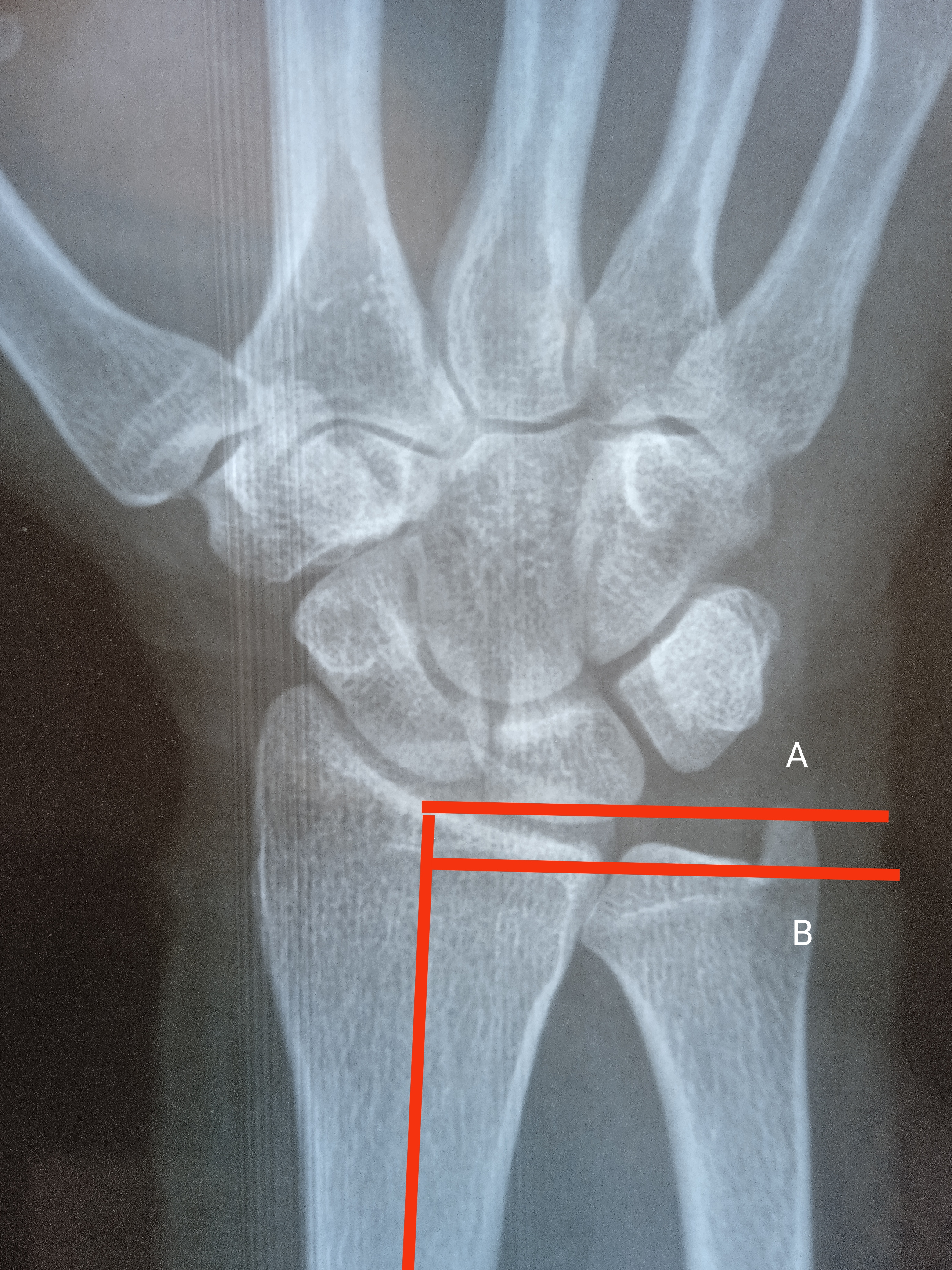 Ulnar Variance: Both lines are perpendicular to the long axis of radius