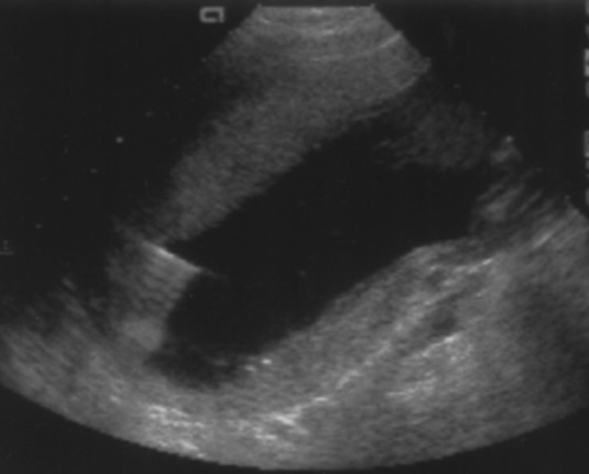 Ultrasound picture showing needle insertion during real time sonography guided amniocentesis