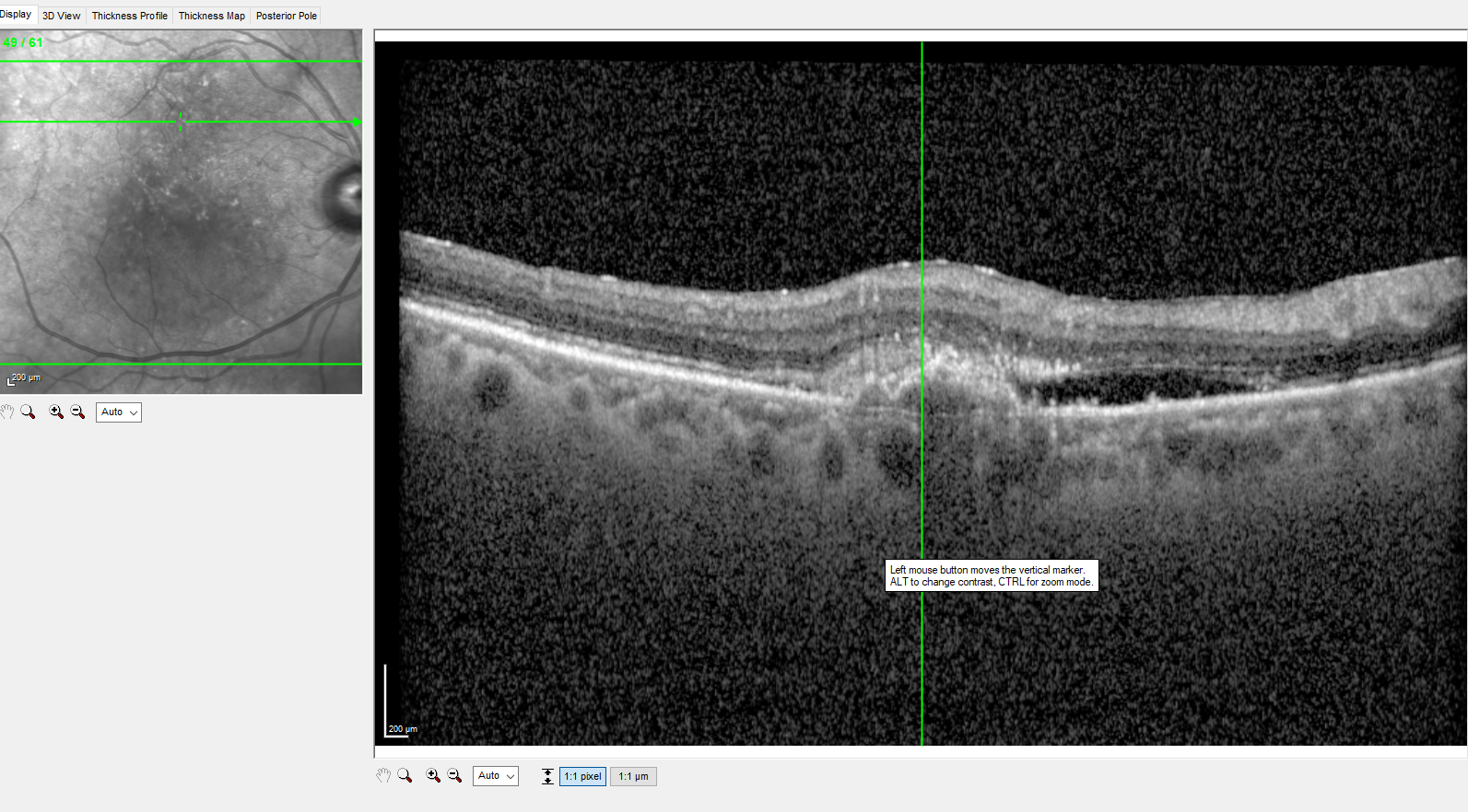 <p>Optical coherence tomography (OCT) image showing neovascular age-related macular degeneration (AMD) with subretinal fluid, retinal pigment epithelial detachment (PED), and subretinal hyperreflective material (SHRM)
