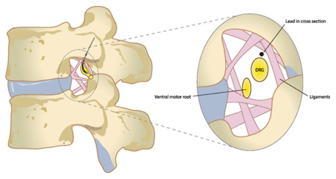 <p>Dorsal Root Ganglion and Proximal Nerve Roots in the Spinal Foramen