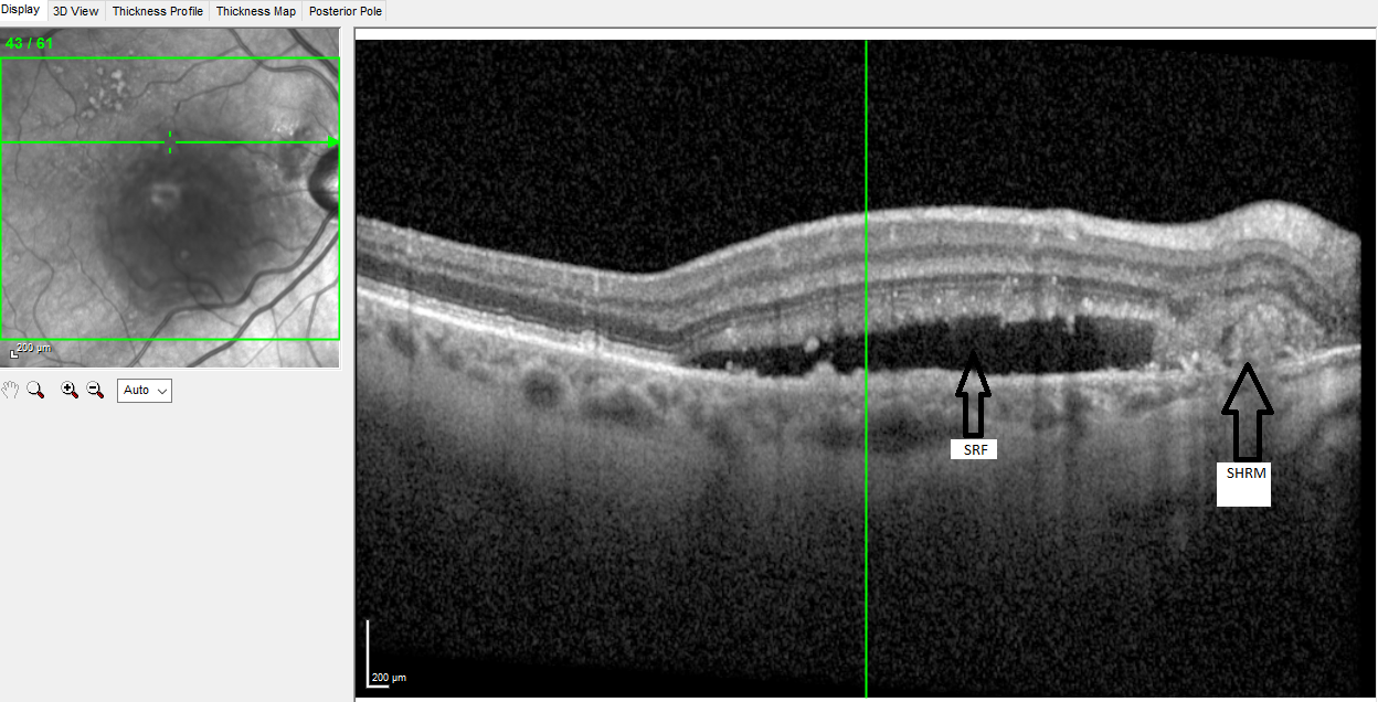 <p>Optical coherence tomography (OCT) image showing peripapillary choroidal neovascular membrane (CNVM) with subretinal hyperreflective material (SHRM) and subretinal fluid (SRF)