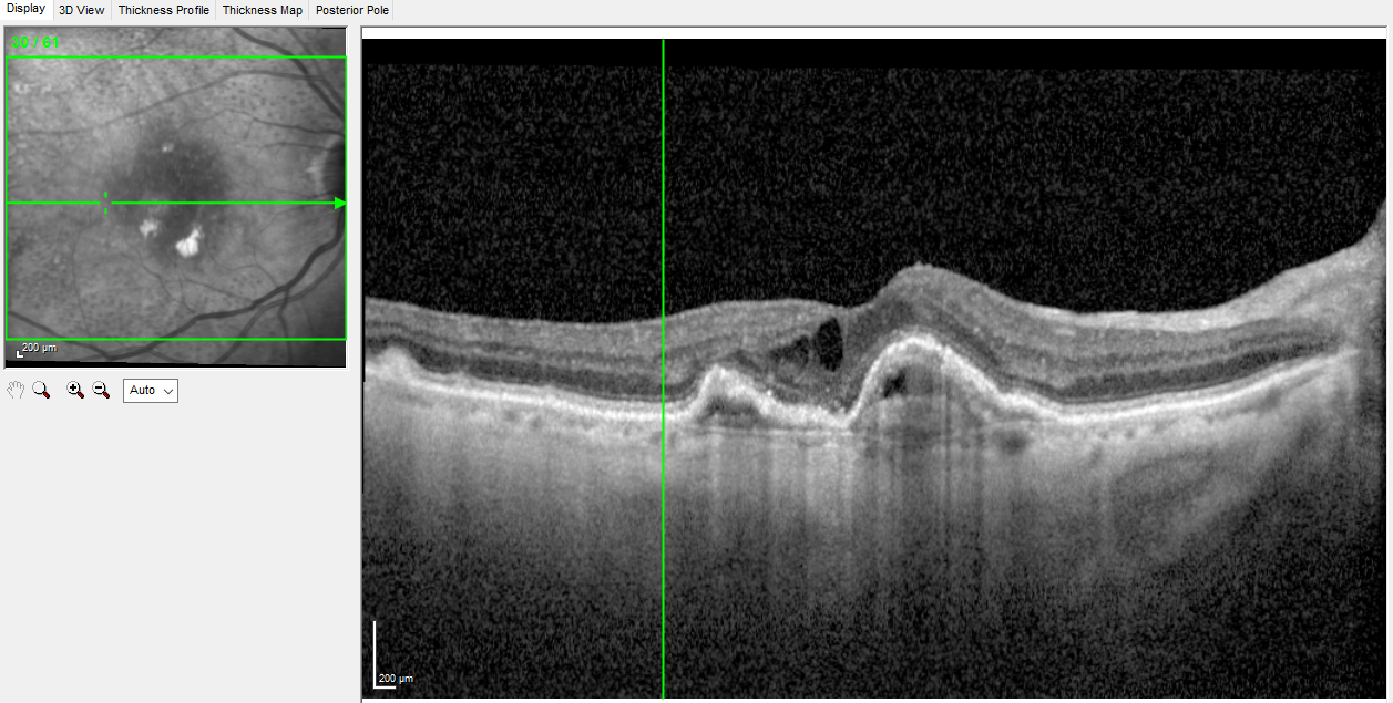 <p>Optical coherence tomography (OCT) image showing wet age-related macular degeneration (AMD) with fibrovascular retinal pigment epithelial detachments (PED) and intraretinal fluid