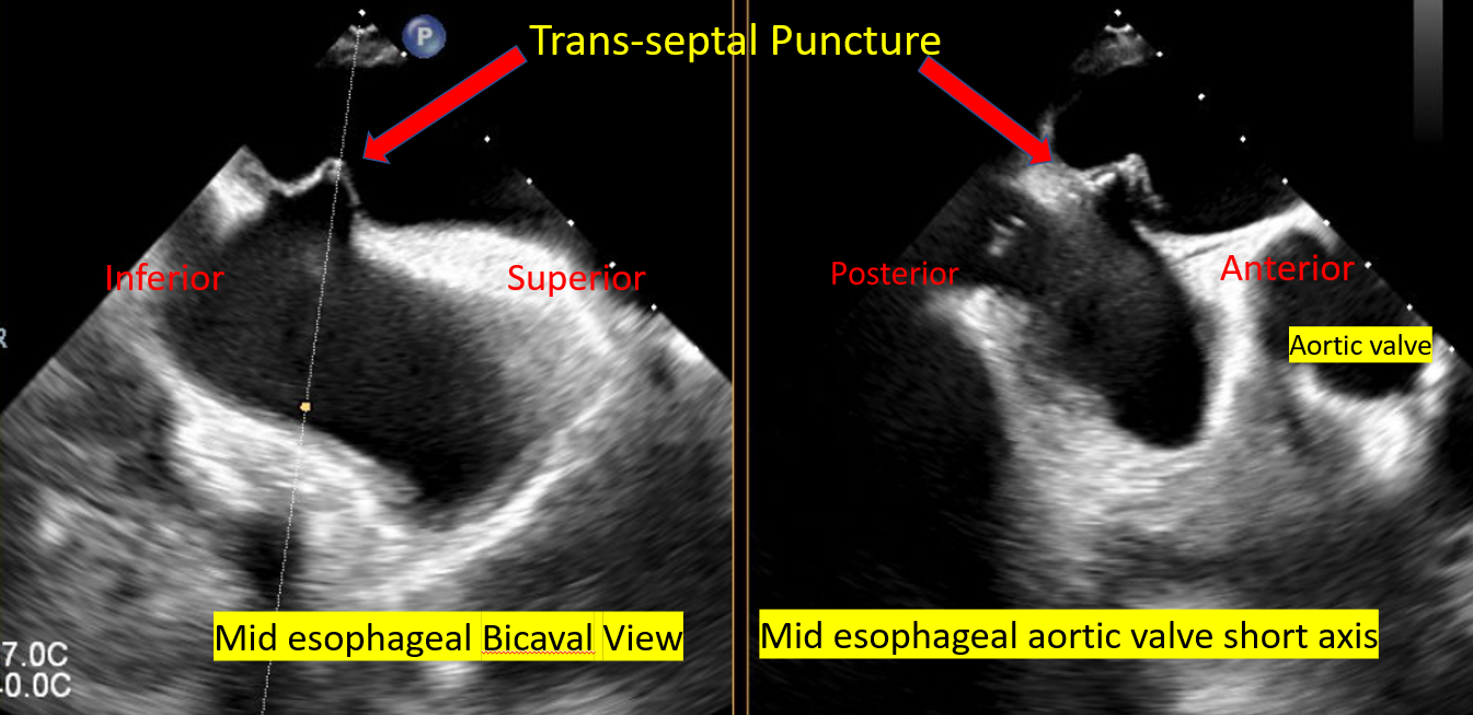 Trans septal Puncture for Mitra Clip Procedure 