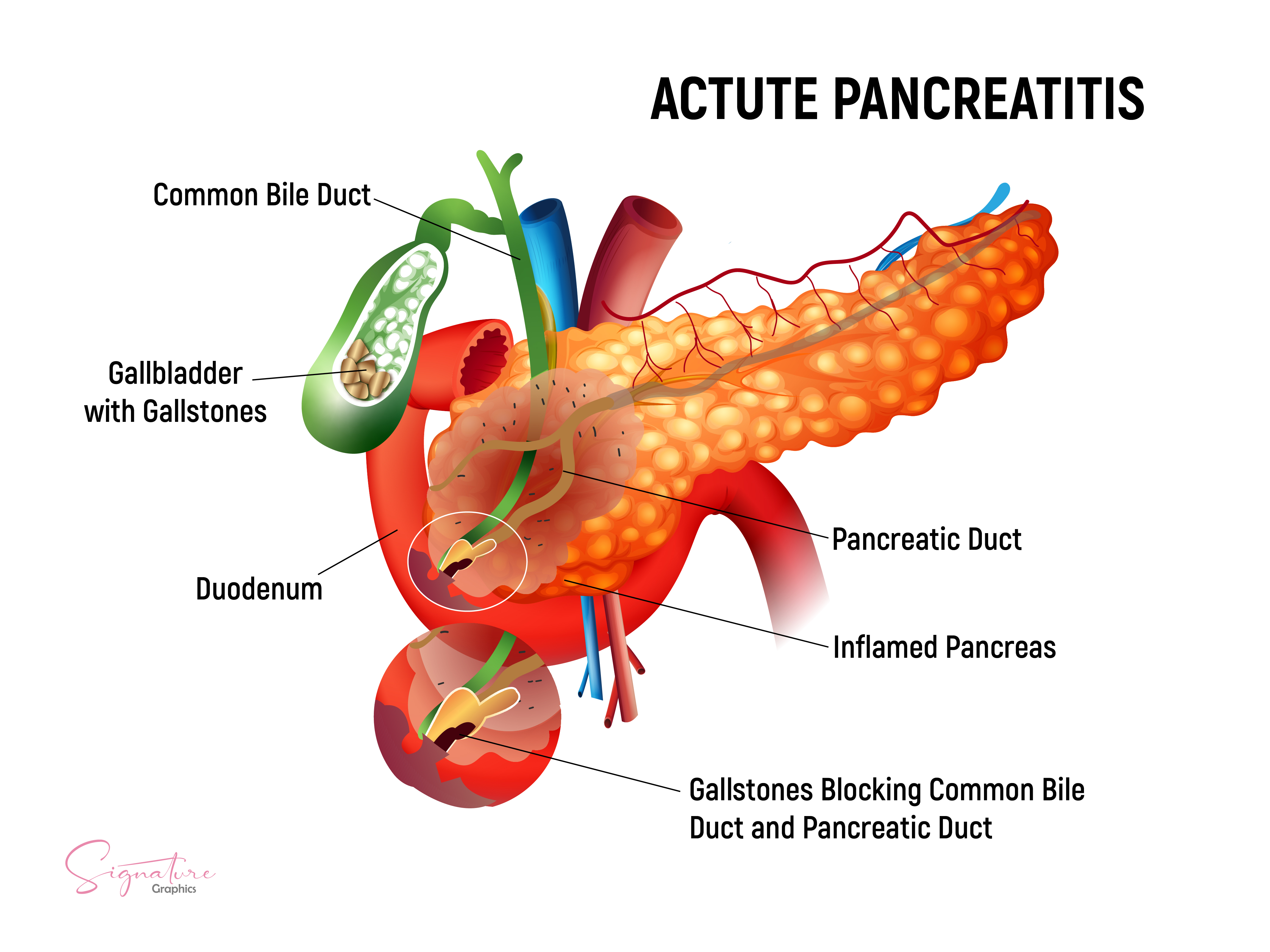 This is a graphic illustration of acute pancreatitis caused by gall stones