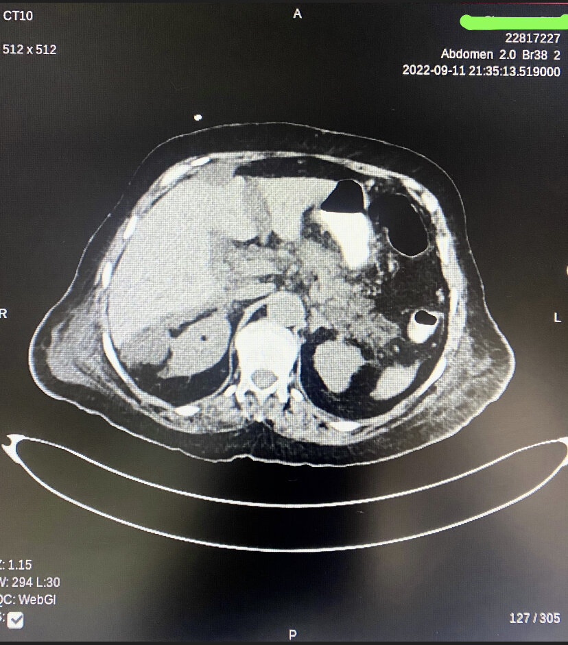 This CT image of patient with necrotising pancreatitis shows extensive peri pancreatic nodularity along with nodularity along the root of mesentery