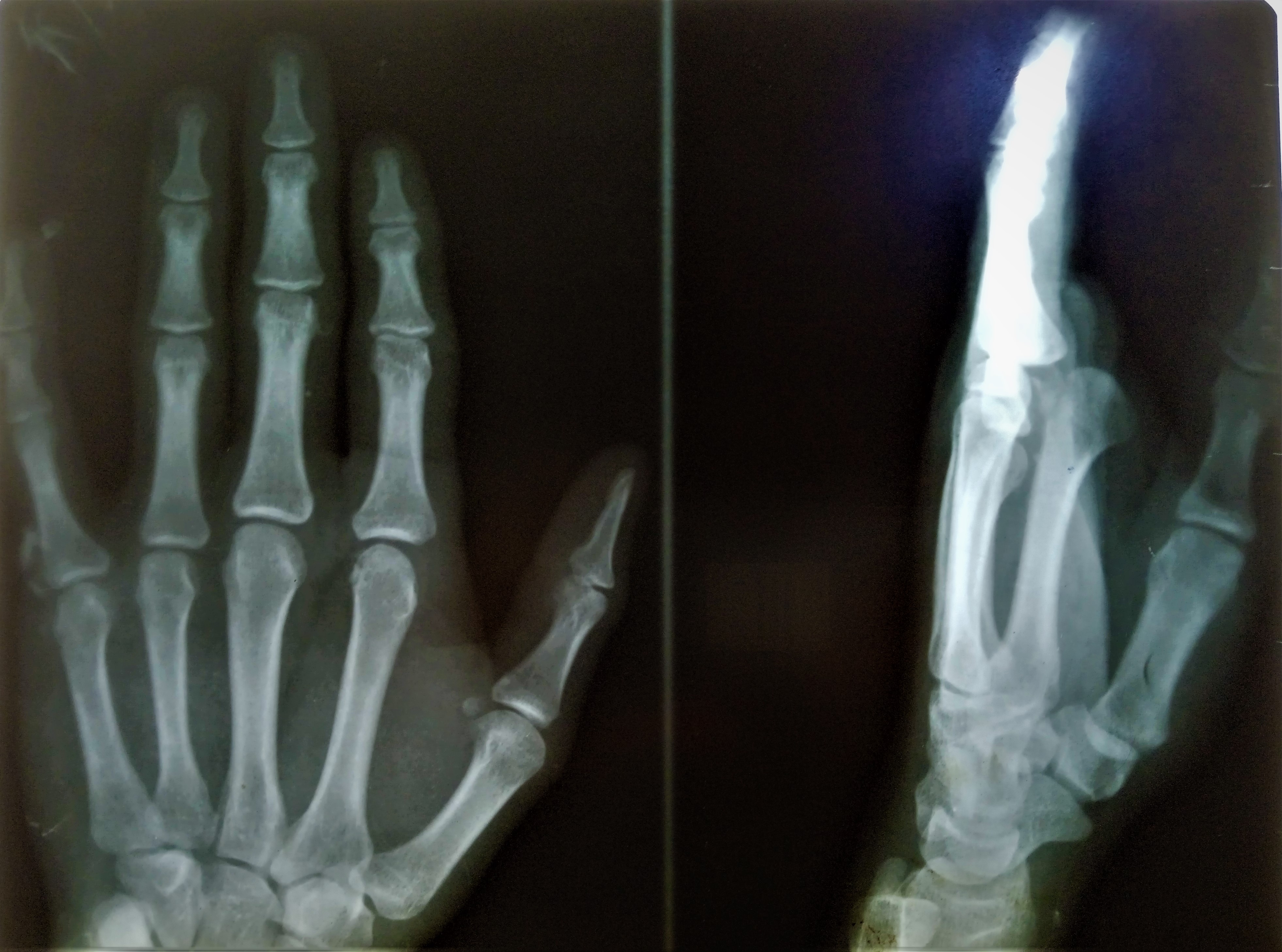 MCP Joint Dorsal Dislocation of Index Finger