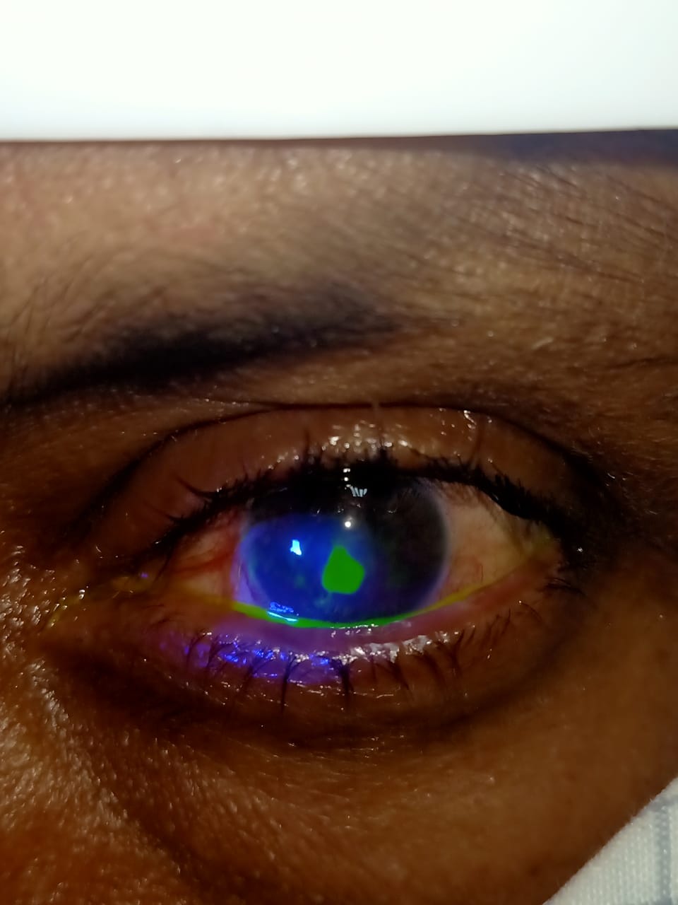Digital image of the patient depicting central epithelial defect post overnight contact lens application