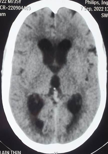 <p>Communicating Hydrocephalus Computed Tomography
