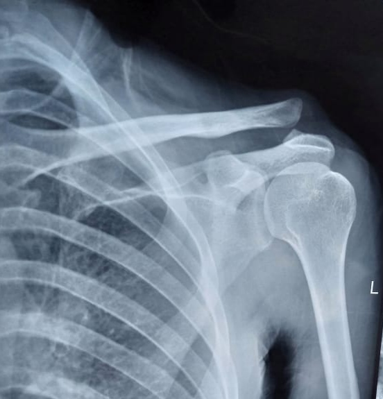 Acromioclavicular joint disruption