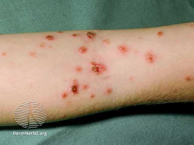 <p>Ulcerated pityriasis lichenoides et varioliformis acuta on the arm</p>