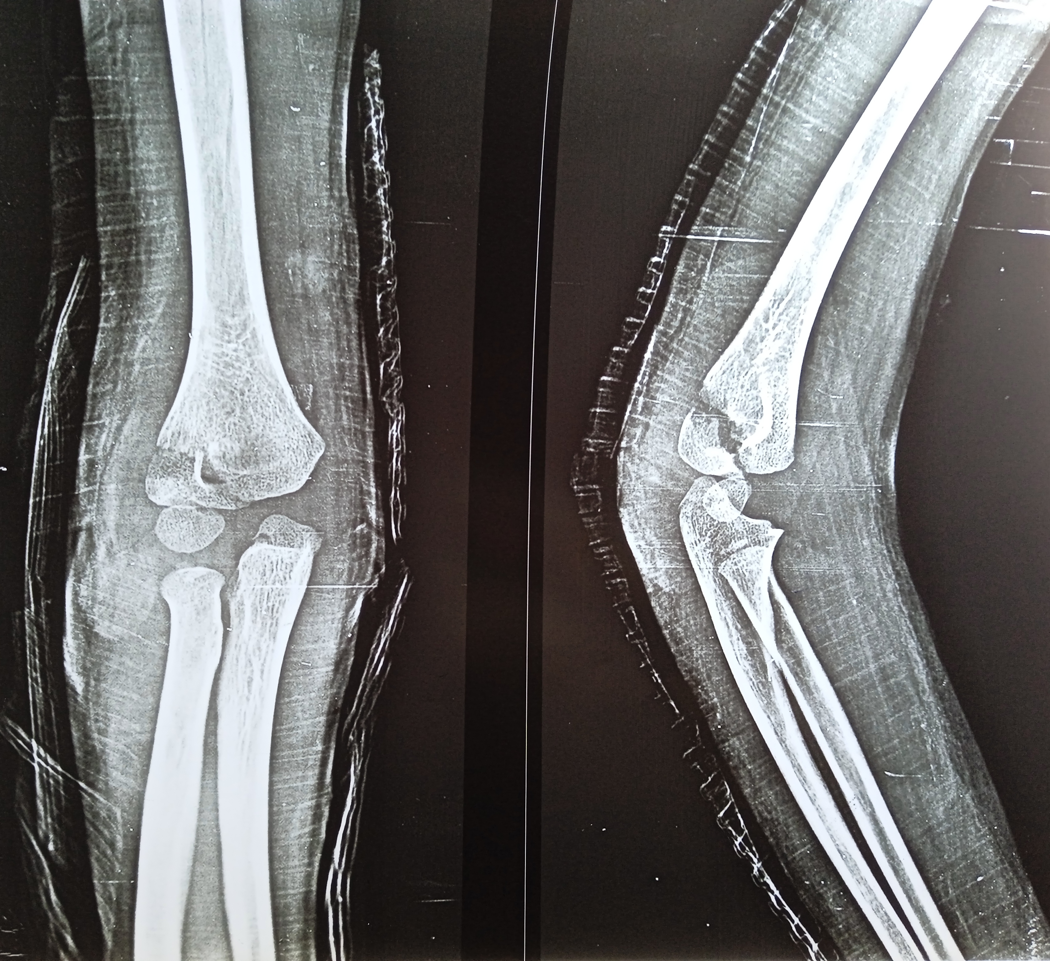 <p>Lateral Humeral Condyle Fracture