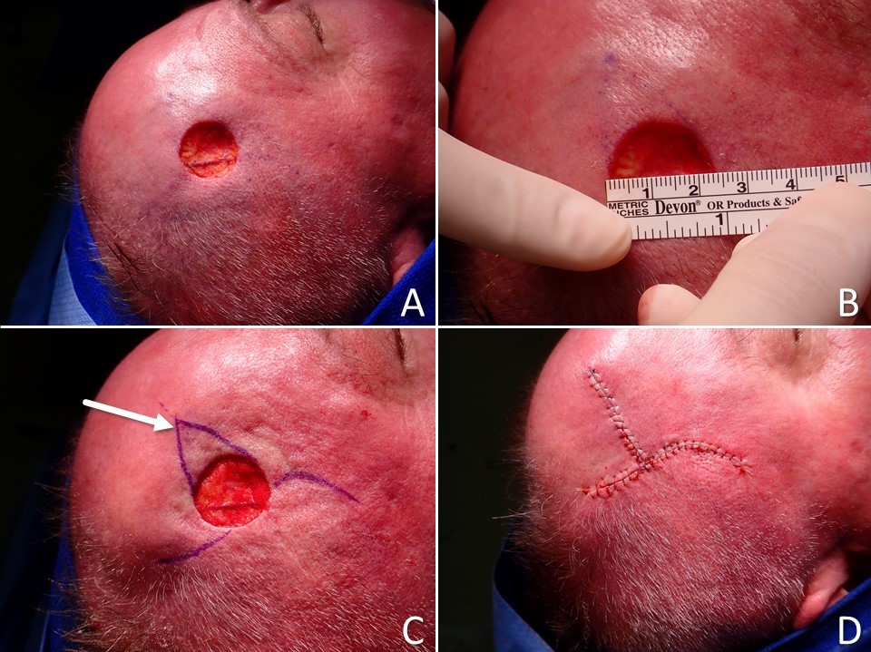 O to T double rotation flap: A) circular full-thickness skin defect resulting from wide local excision of a melanoma, B) the defect measures 22 mm in diameter, C) double rotation flaps are planned for closure with the inferior (right side of image) flap having an advancement component that permits the back cut to lie along the temporal hairline and the superior flap (left side of image) having a more conventional design (the arrow indicates the triangular standing cutaneous deformity that will be removed), D) the defect is closed with the limbs of the incision well hidden along the hairline and within a transverse forehead rhytid.