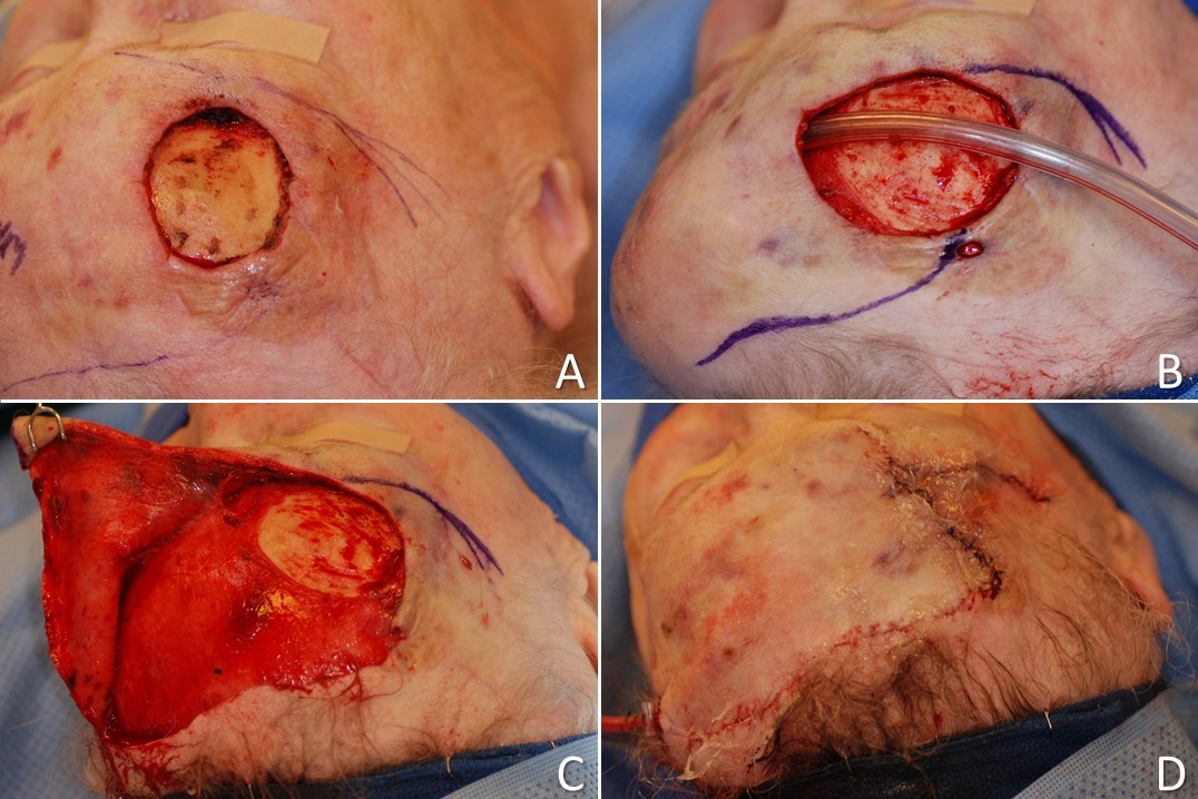 O to Z double rotation flap: A) circular full thickness defect with exposed calvarium due to recurrent and aggressive basal cell carcinoma measures ~3 cm in diameter, B) O to Z incisions are planned and intraoperative tissue expansion is performed using a Foley catheter balloon, C) the first flap is elevated in a subgaleal plane, D) the rotational flaps are transferred over a suction drain, leaving the characteristic Z-shaped scar.