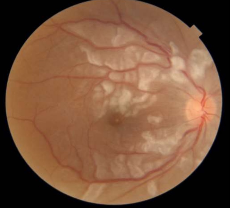 Purtscher-like retinopathy in systemic lupus erythematosus (SLE) [right eye]