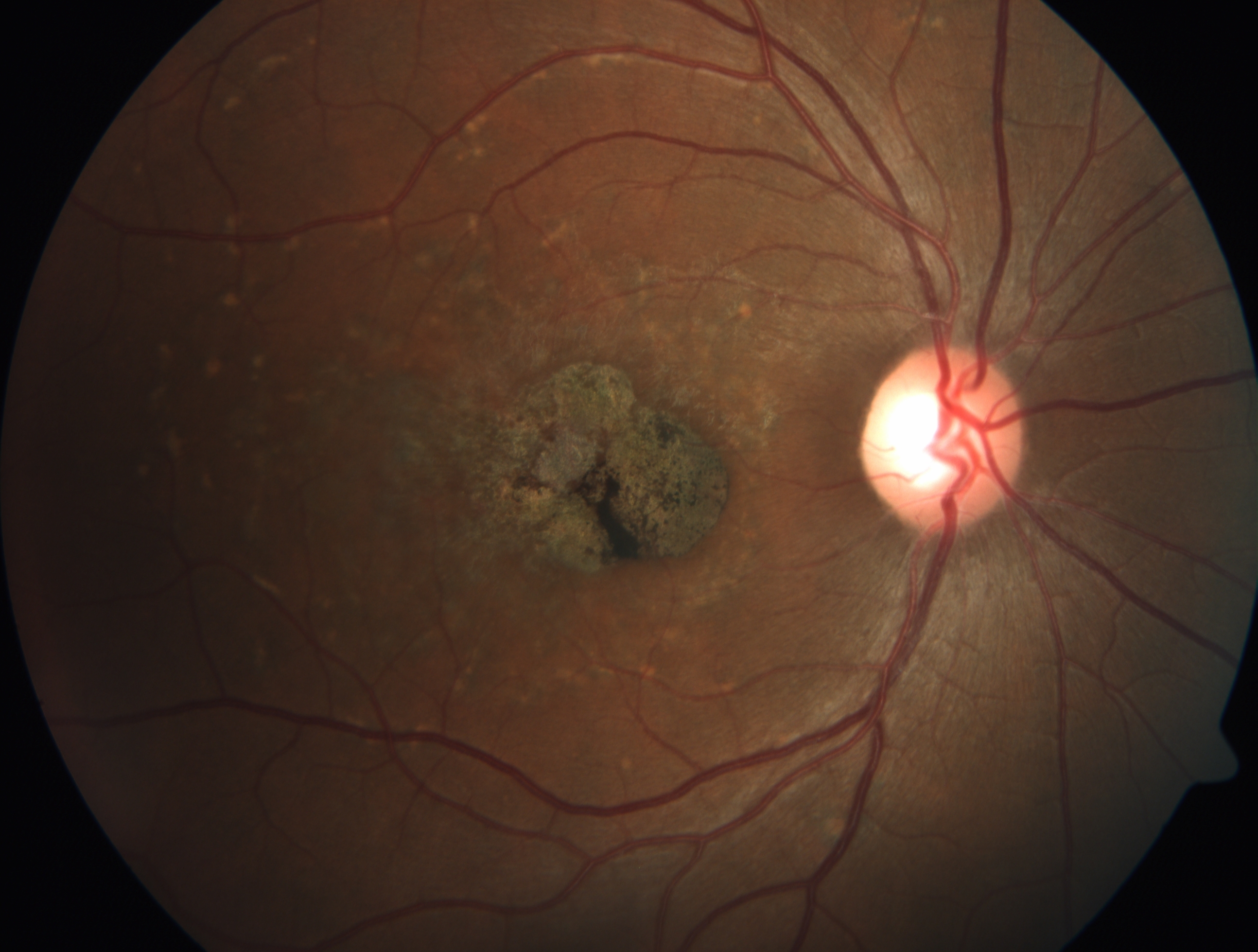 <p>Fundus With Bronze-Beaten Appearance