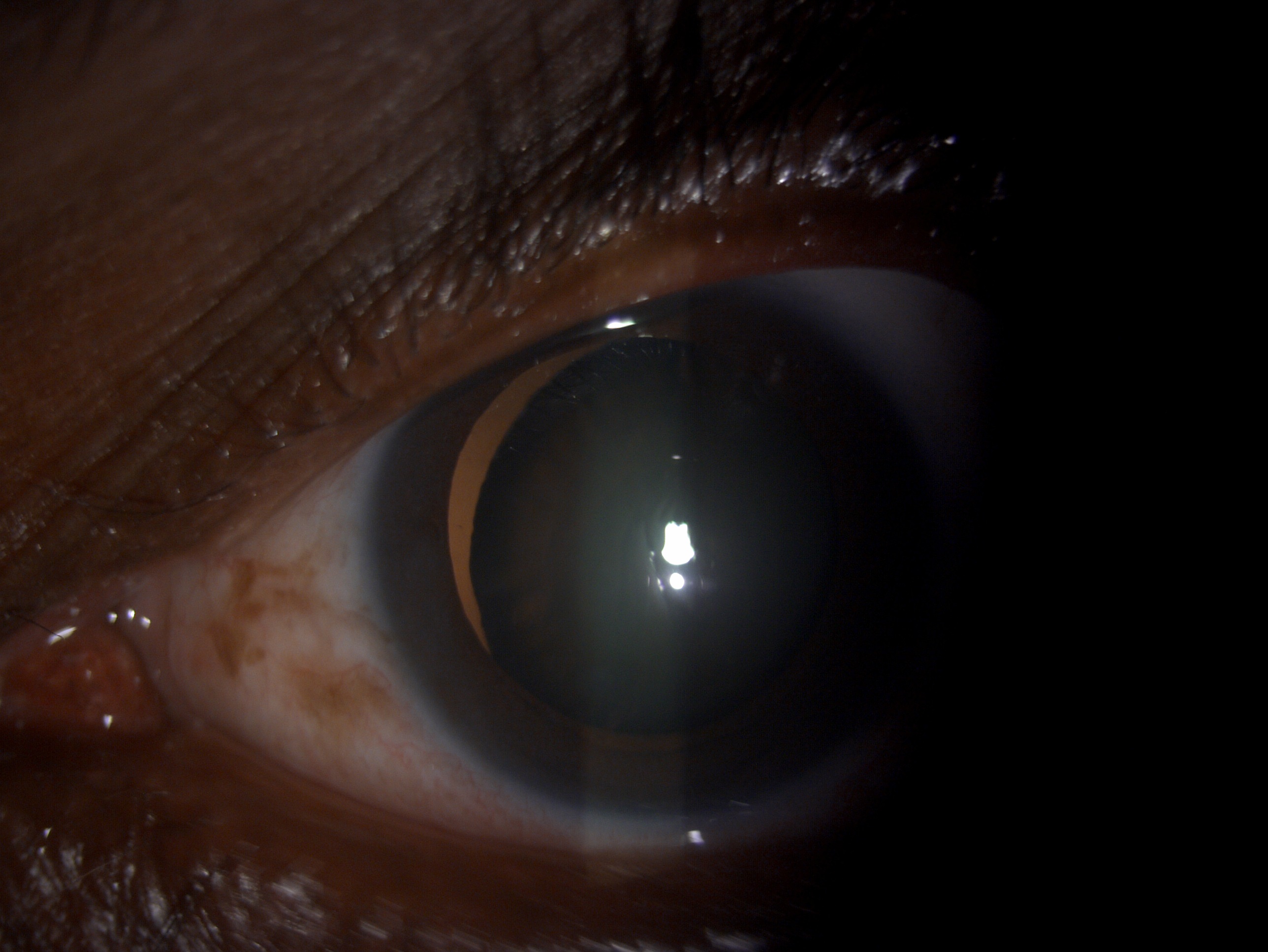 Digital retro-illumination slit lamp image of the patient depicting microspherophakic lens