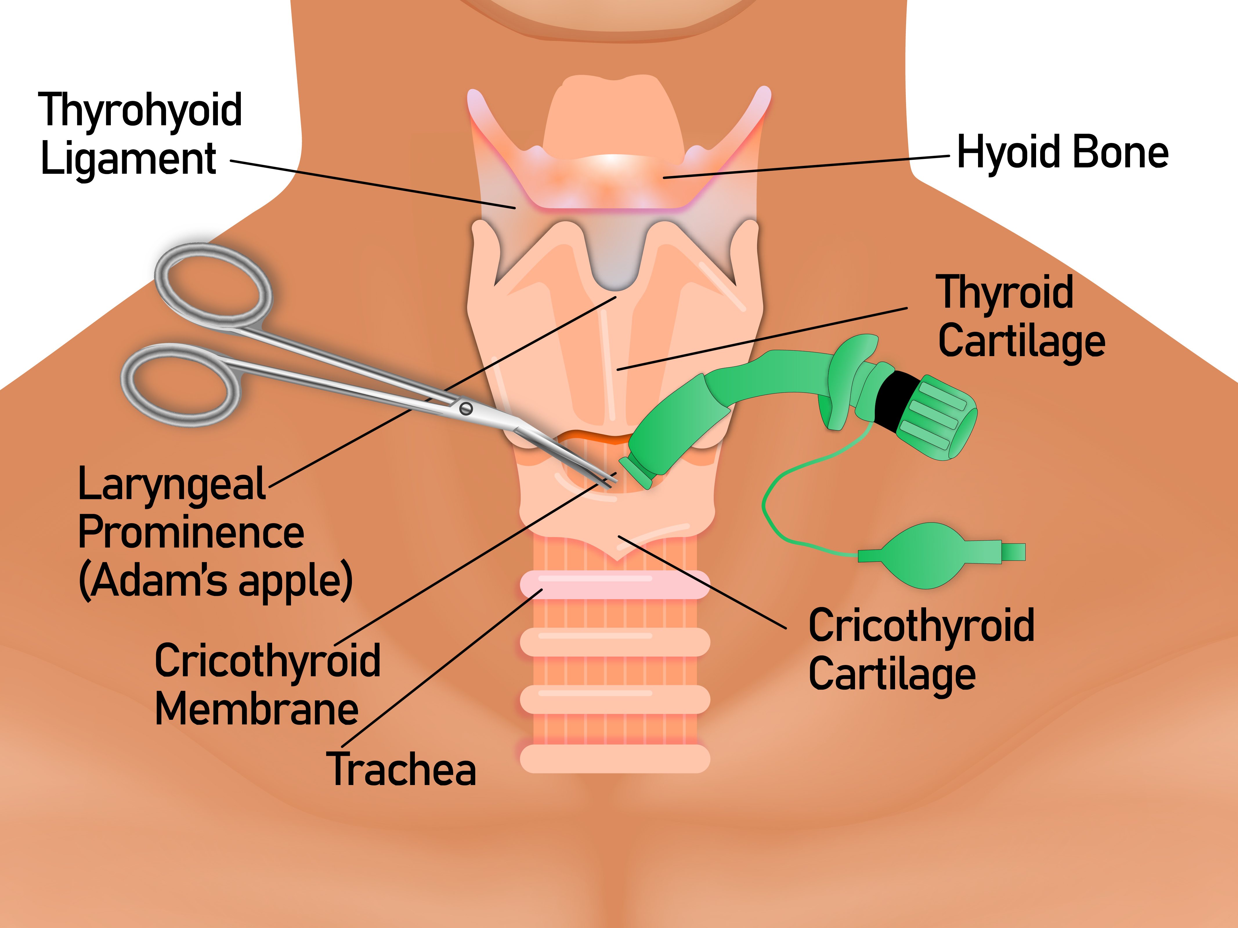 This image illustrates the anatomy and the framework of airway in the neck region. The cricothyroid membrane is located between the thyroid cartilage superiorly and the cricoid cartilage inferiorly. The cricothyroid membrane must be identified by palpation of the surrounding cartilaginous structures.