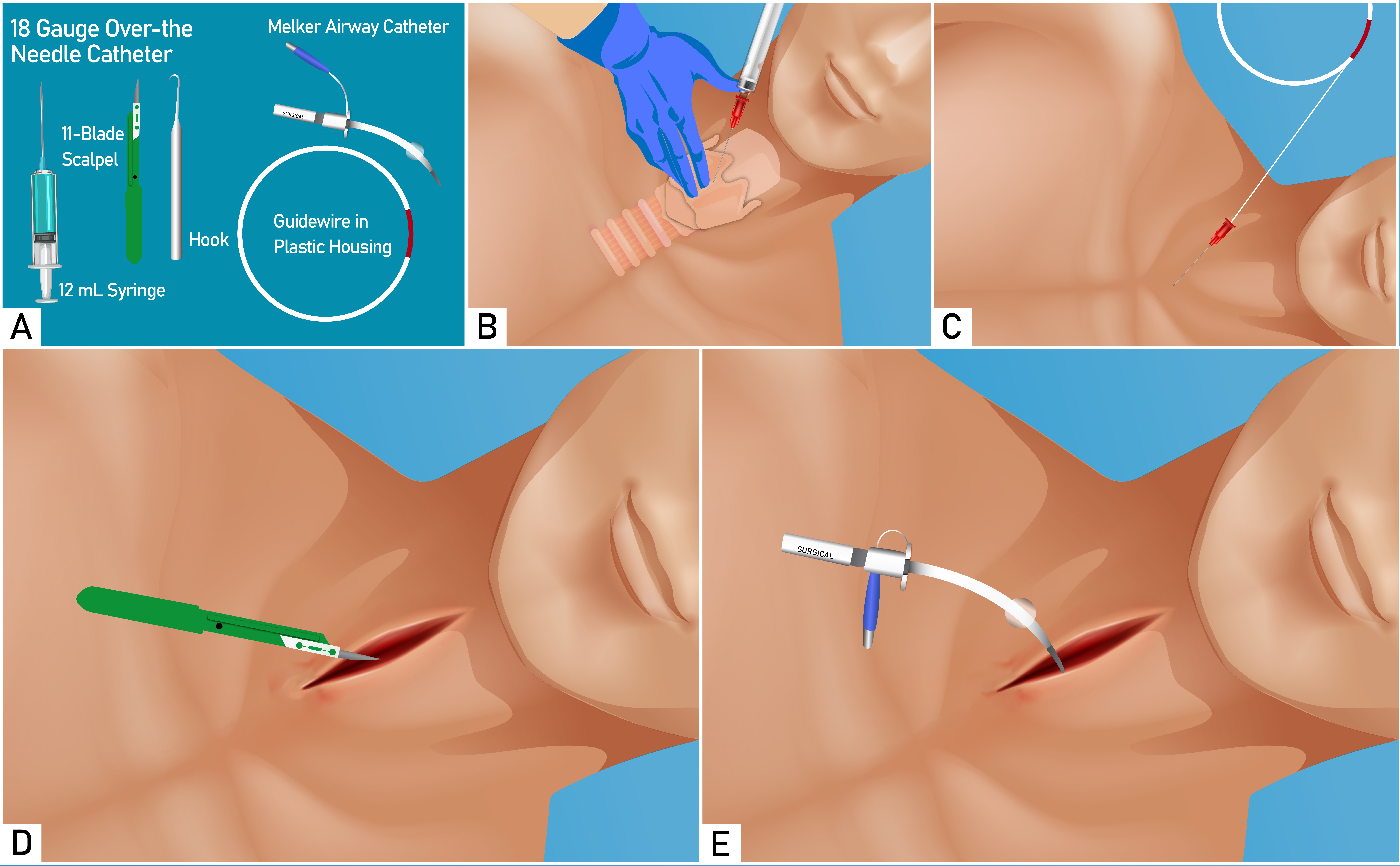 This image illustrates the equipment required for cricothyroidotomy and stepwise approach to perform the procedure.