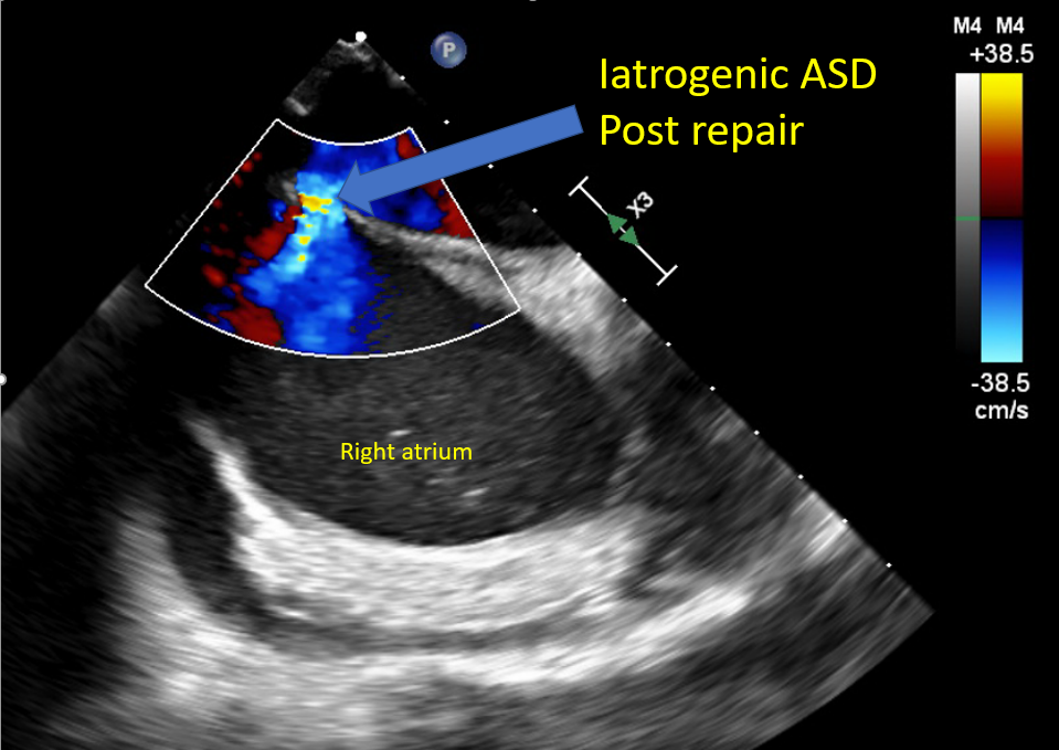 <p>Iatrogenic Atrial Septal Defect. The image shows the posttranscatheter edge-to-edge valve repair.</p>
