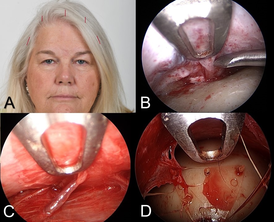 Endoscopic brow lift: A) Location of 5 incisions around the frontotemporal scalp. B) Elevation of the periosteum to the level of the superior orbital rims, including exposure of the supraorbital nerves. C) The medial zygomaticotemporal "sentinel" vein lies within 1 cm of the frontal branch of the facial nerve and serves as an intraoperative marker for the nerve. D) Resorbable polymer implants are placed to fixate the forehead periosteum in an elevated position.