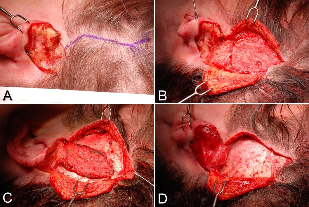 Temporoparietal fascia flap (TPFF): A) postauricular defect from Mohs surgery with too much bare cartilage for a skin graft alone to survive. A Y-shaped incision is planned paralleling the course of the superficial temporal artery. B) The scalp flaps are elevated in a subdermal plane and the temporoparietal fascia exposed. C) The TPFF is incised on three sides, with the pedicle intact inferiorly. D) The TPFF is transferred into the defect, after which the scalp will be closed in layers and a skin graft applied to the flap.