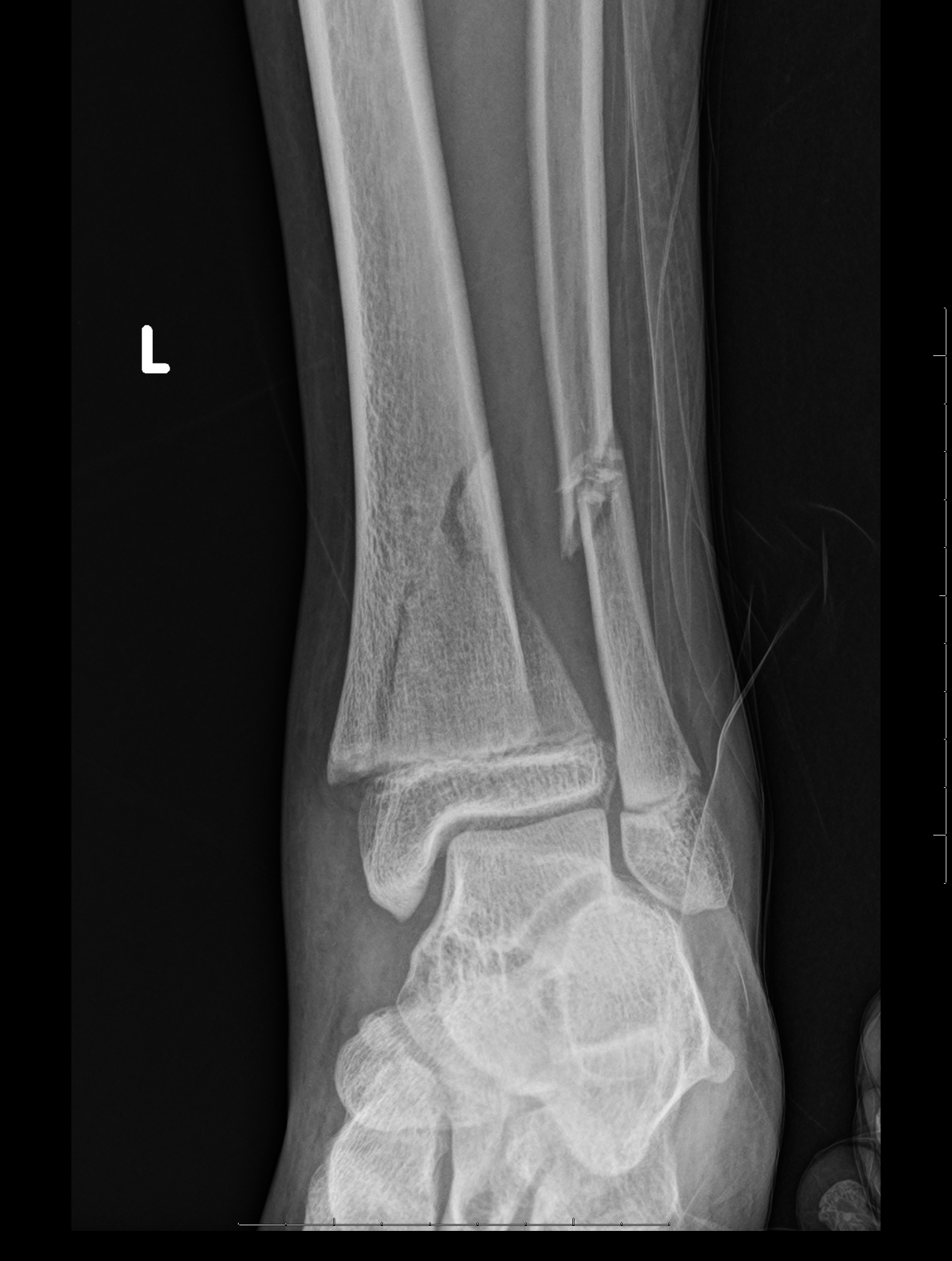 Oblique view of the ankle demonstrating a fracture through the physes and the metaphyses consistent with a Salter-Harris type 2 fracture
