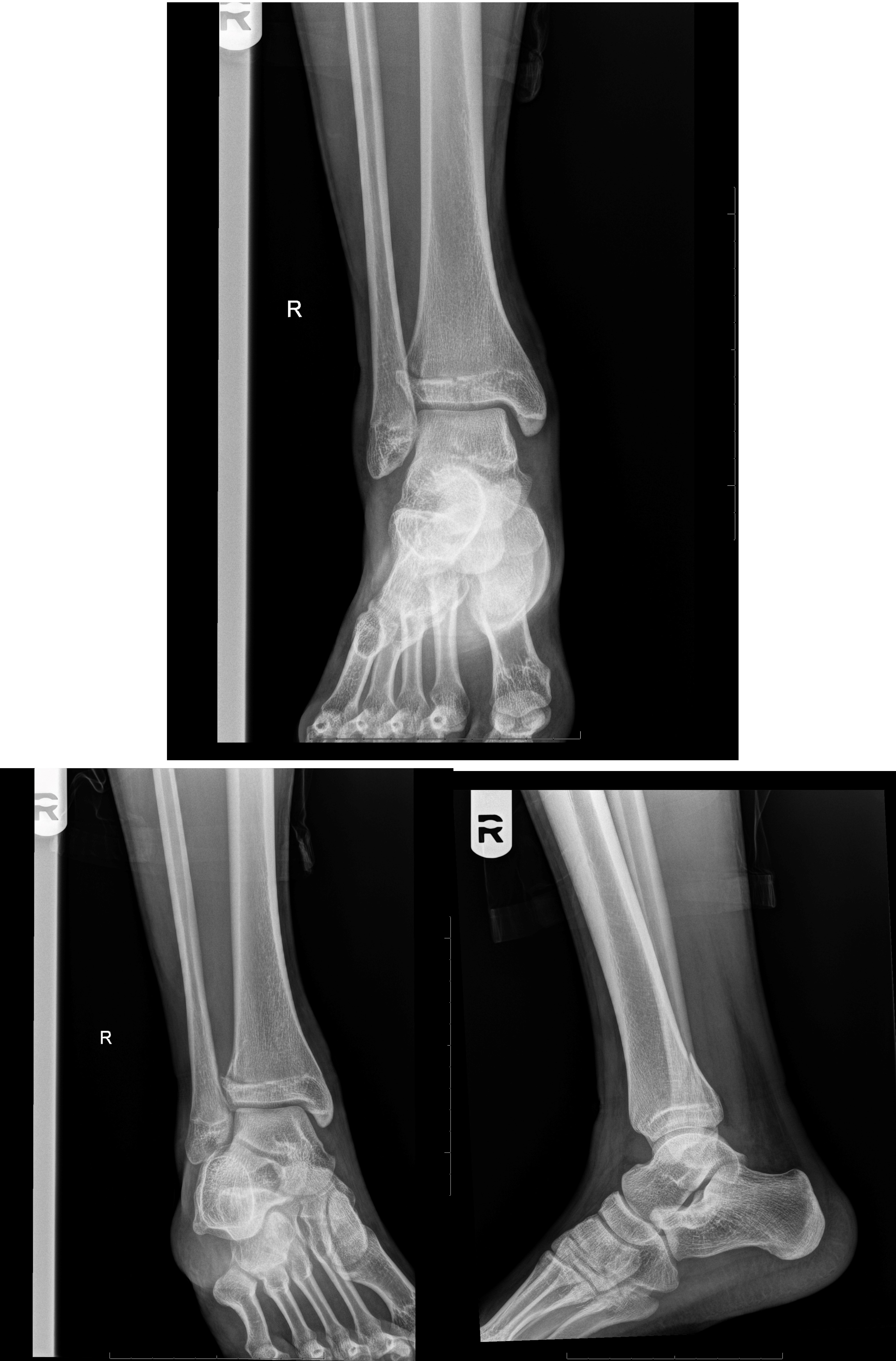 3 views of the ankle demonstrating a vertical fracture component through the distal epiphysis, a transverse fracture componen