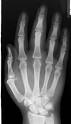 <p>PA Hand X-ray</p>
<p>&nbsp;</p>