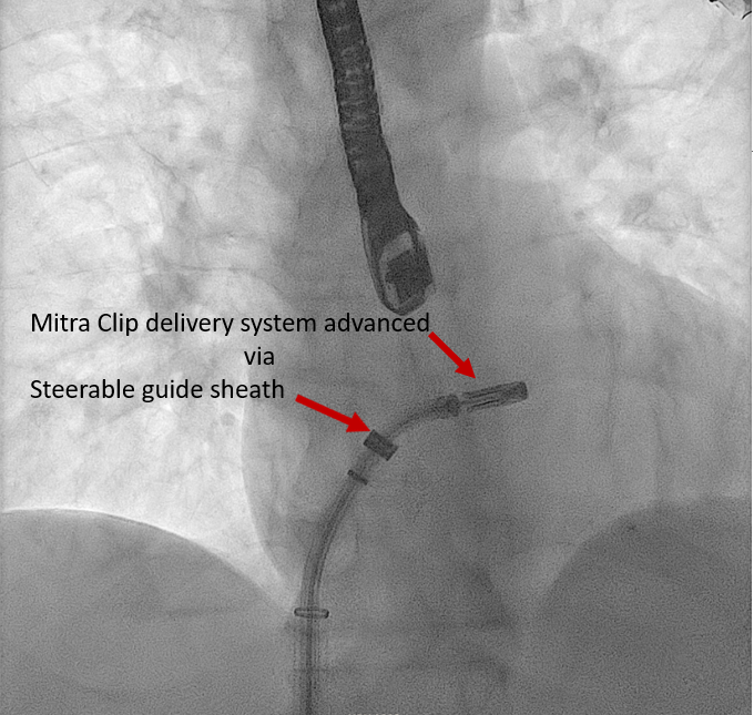 <p>MitraClip Delivery System. The MitraClip delivery system is being advanced by the steerable guide sheath.</p>