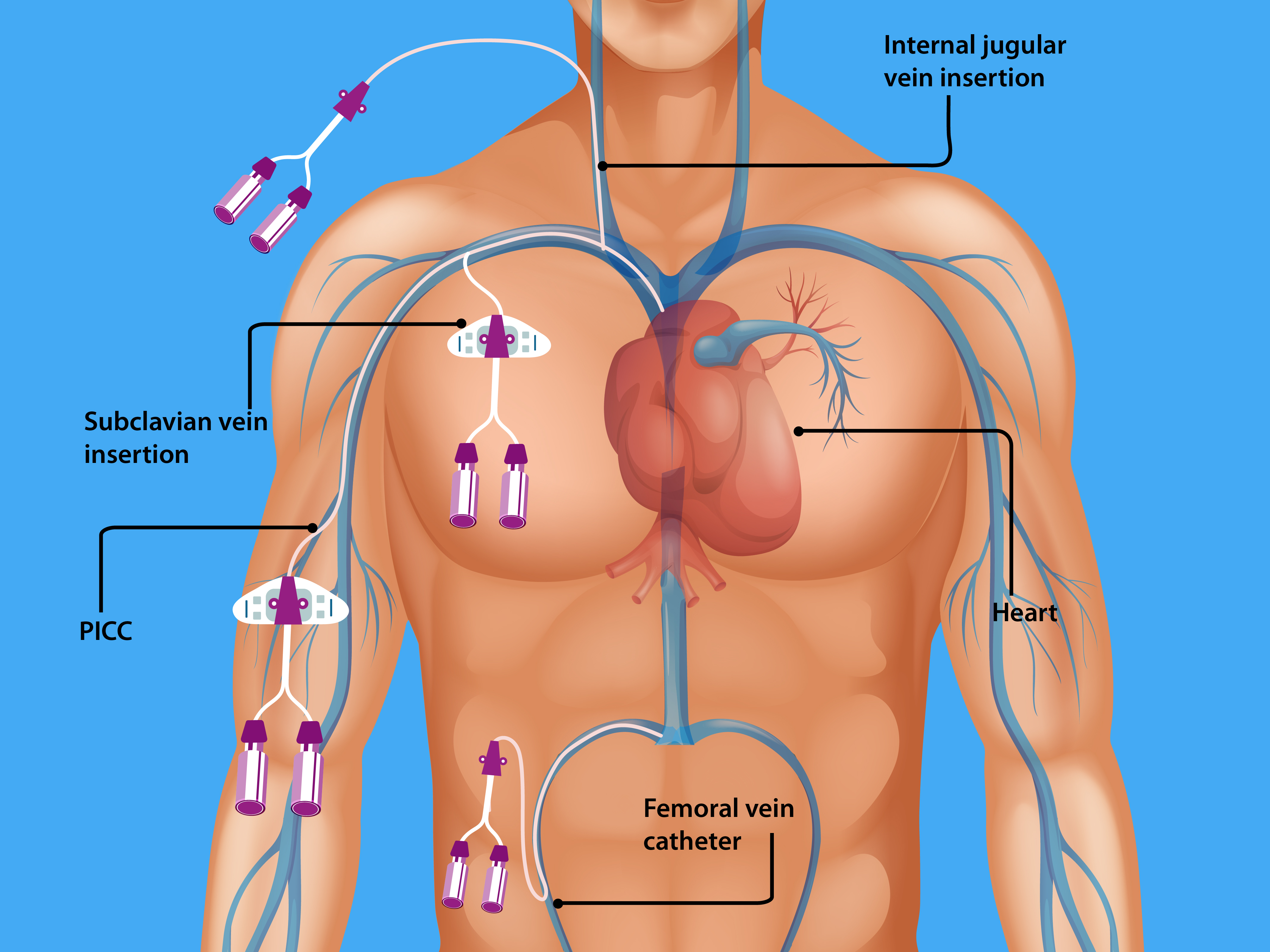 This image shows different access in the body for central venous catheterization.