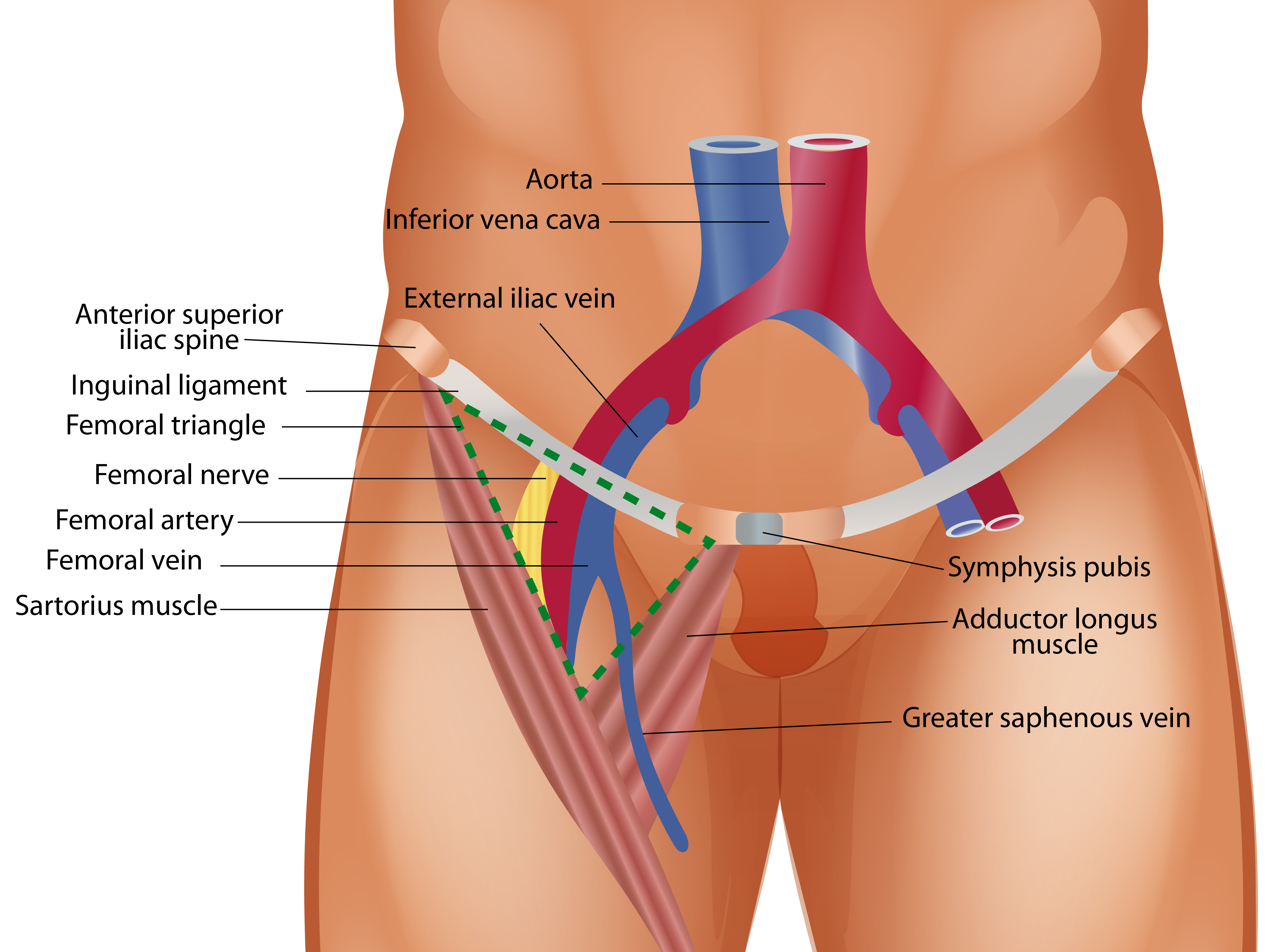 This figure illustrates femoral triangle, bounded superiorly by inguinal ligament, laterally by medial border of sartorius muscle and medially by lateral border of adductor longus muscle. Clinically this area is used for femoral vvein access for central venous catheterization. From medial to lateral the structures are in the following order VAN; femoral vein, femoral artery and femoral nerve. 