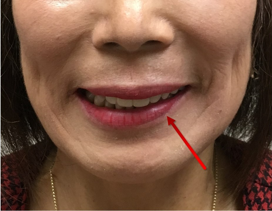 Lower lip asymmetry after rhytidectomy due to injury to the nerve that controls the depressor labii inferioris muscle. The left side (arrow) is affected; the patient cannot depressor her lower lip on that side.
