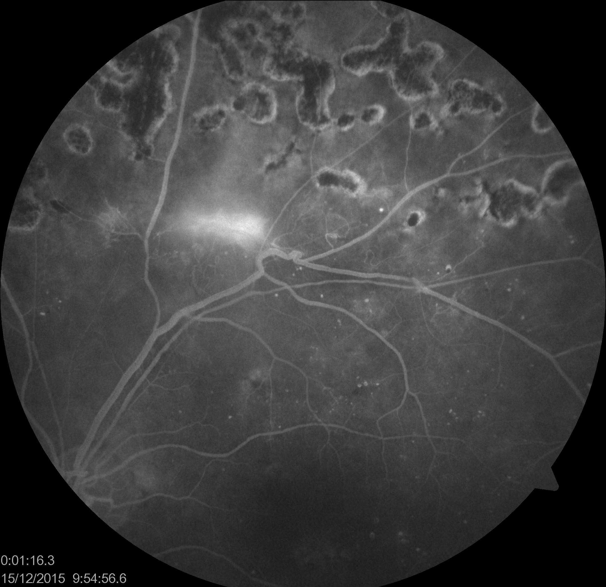 New vessel elsewhere (NVE) in the retina in a patient with proliferative diabetic retinopathy (with history of panretinal photocoagulation)