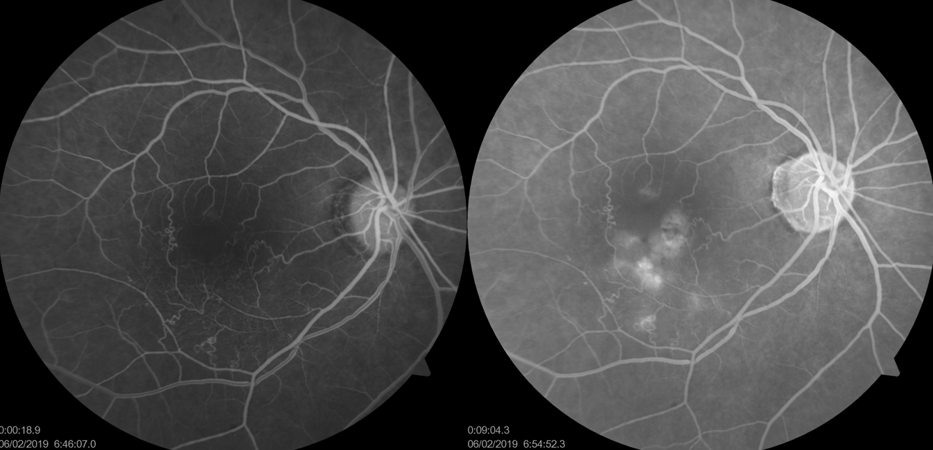 FFA of macular branch retinal vein occlusion (BRVO)