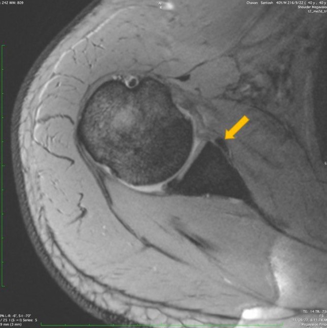 axial section of shoulder MRI showing Bankart lesion