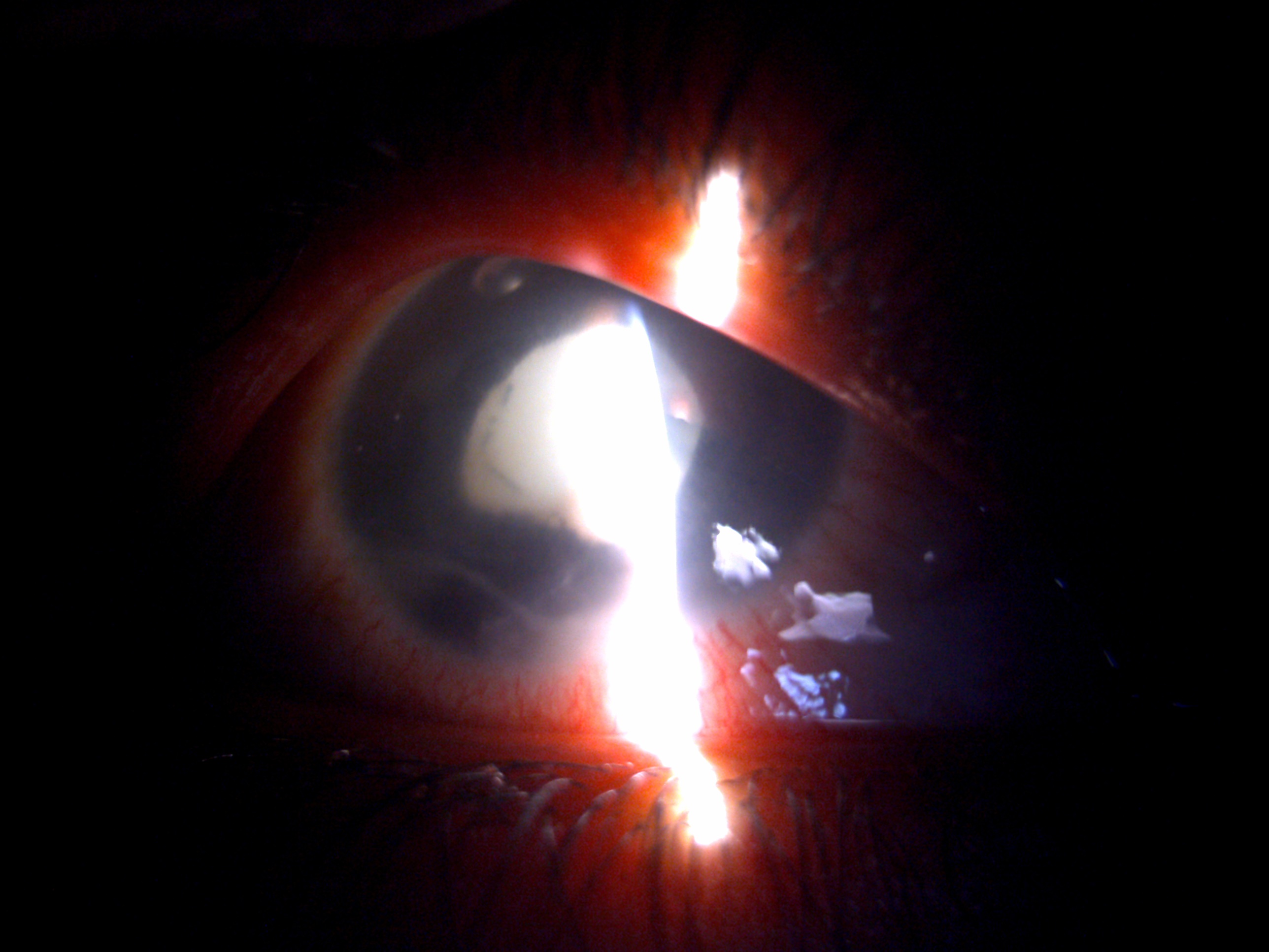 Digital slit lamp image of the patient depicting corneal tear with heteregenous lenticular opacity suggestive of lens abscess