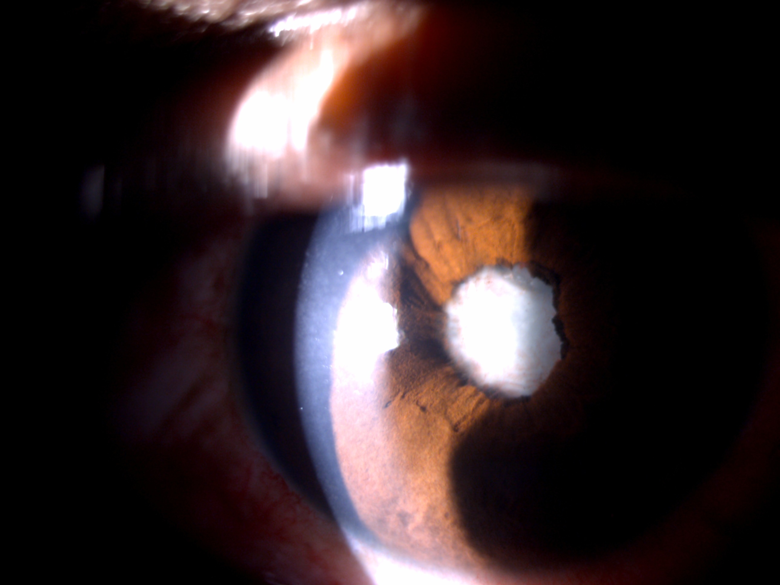 Digital image of the patient depicting a case of lens abscess