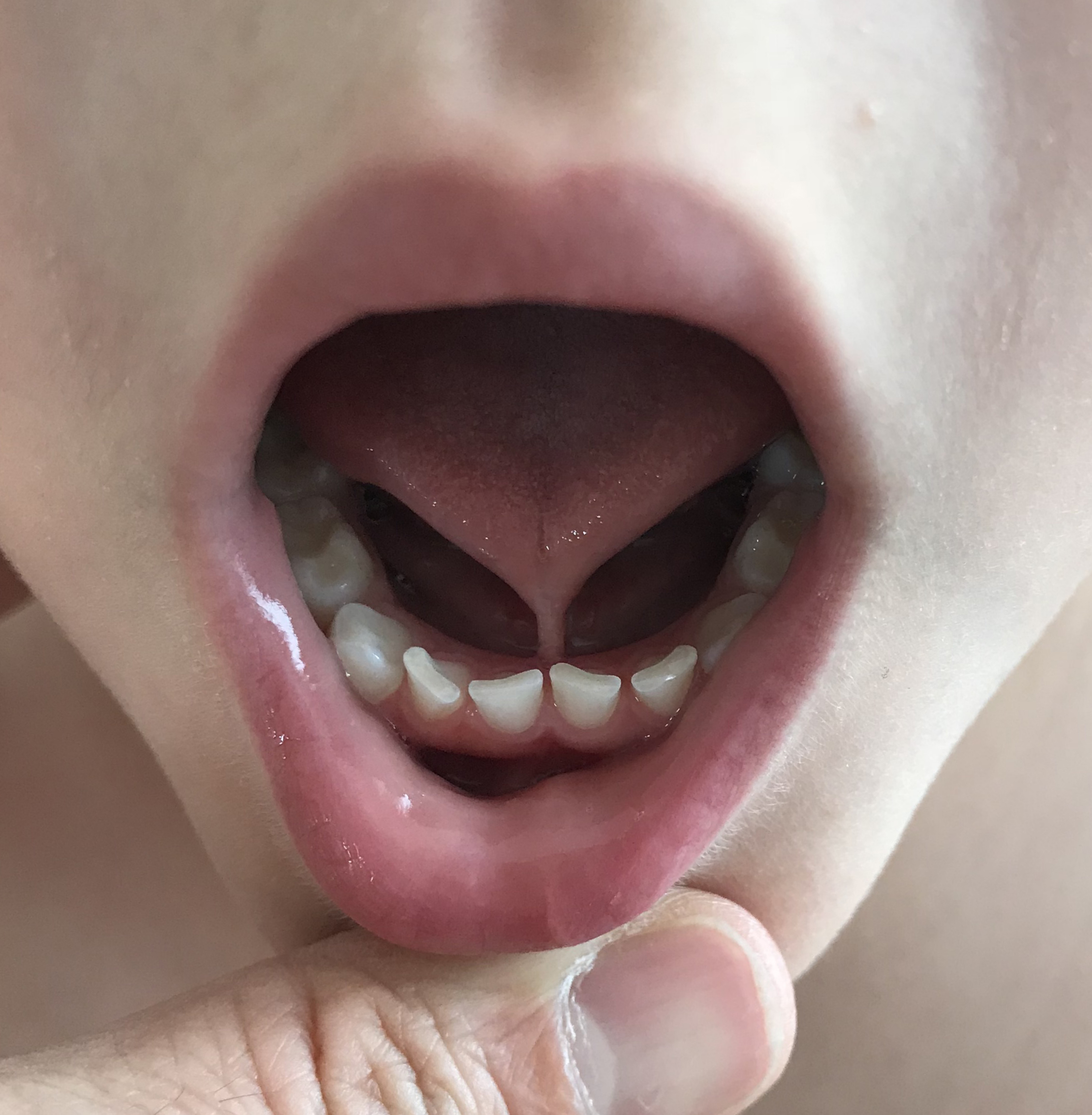 Ankyloglossia. Note the lingual frenulum attachment at the tip of the tongue.