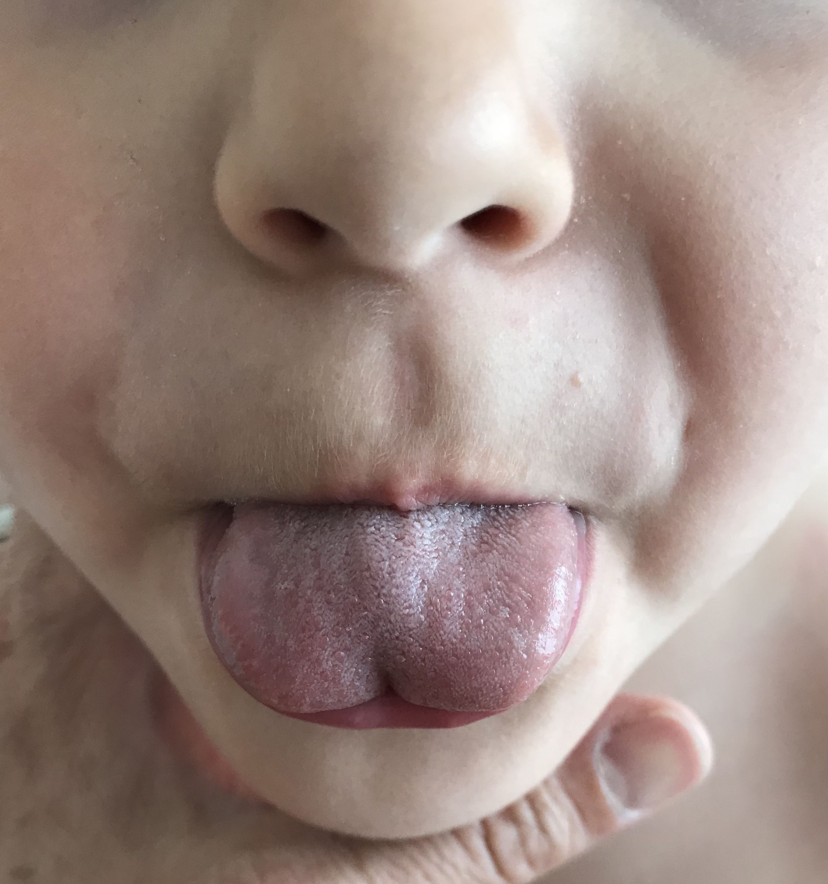 Heart-shaped deformity of the tongue due to ankyloglossia.
