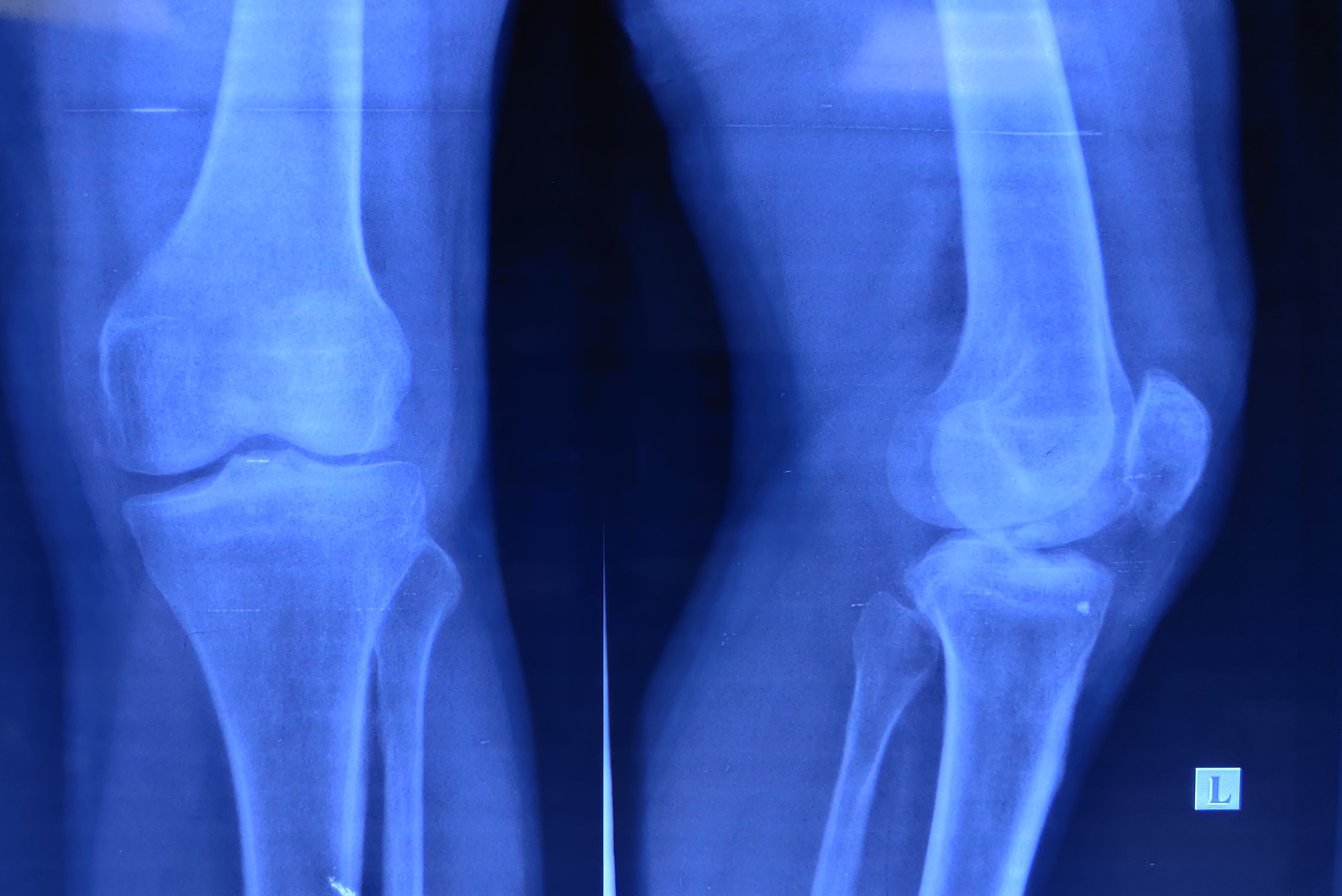 <p>Left Knee Tibial Eminence Fracture