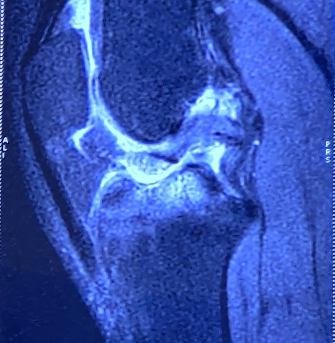 <p>Tibial Eminence Fracture Magnetic Resonance Imaging