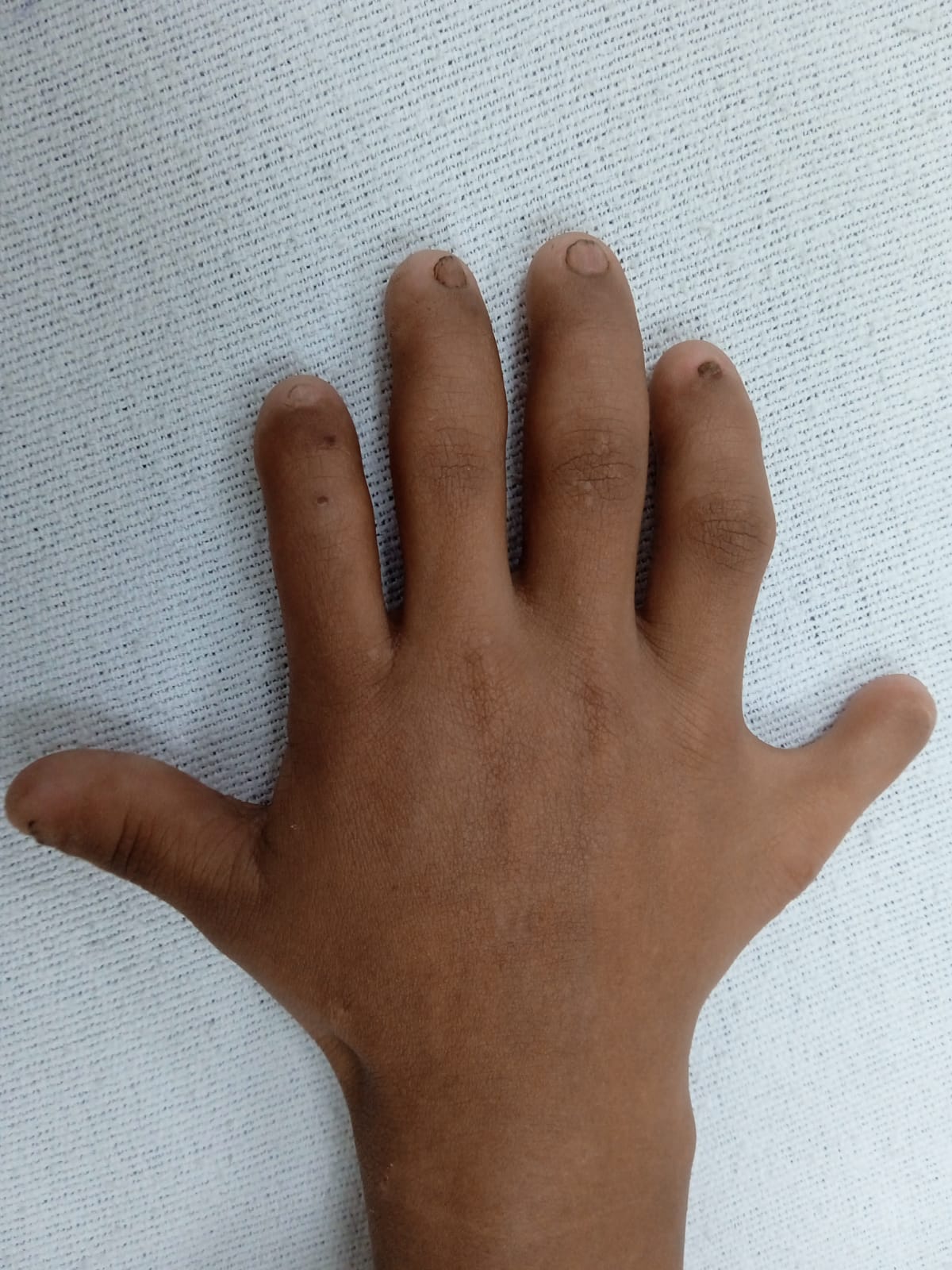 Postaxial polydactyly