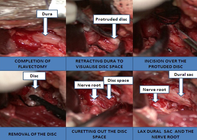 Steps in Micro-lumbar discectomy (MLD)
