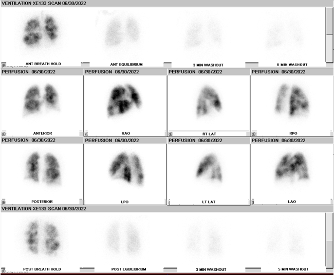 V/Q scan showing matched ventilation and perfusion defects signifying a low probability result according to modified PIOPED II criteria