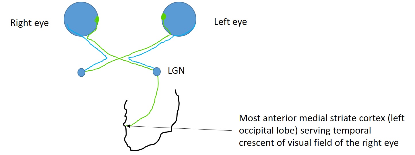 Schematic for the visual pathway carrying information from the temporal crescent