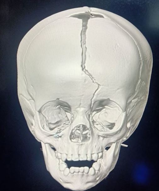 Diastatic fracture involving superior sagittal sinus that harbinger high risk of developing leptomeningeal cyst in the child